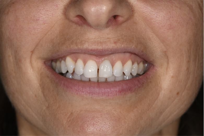 A difficult clinical situation with a high smile line, patient with high expectations and a failing upper left central incisor