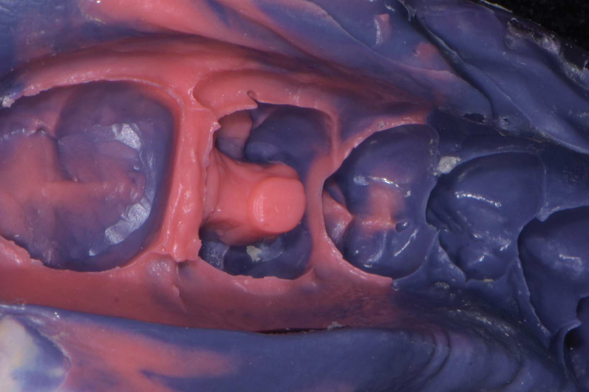 Alan Cantagalli presents an onlay restoration case using natural-looking onlays, digital scanning and CAD design.