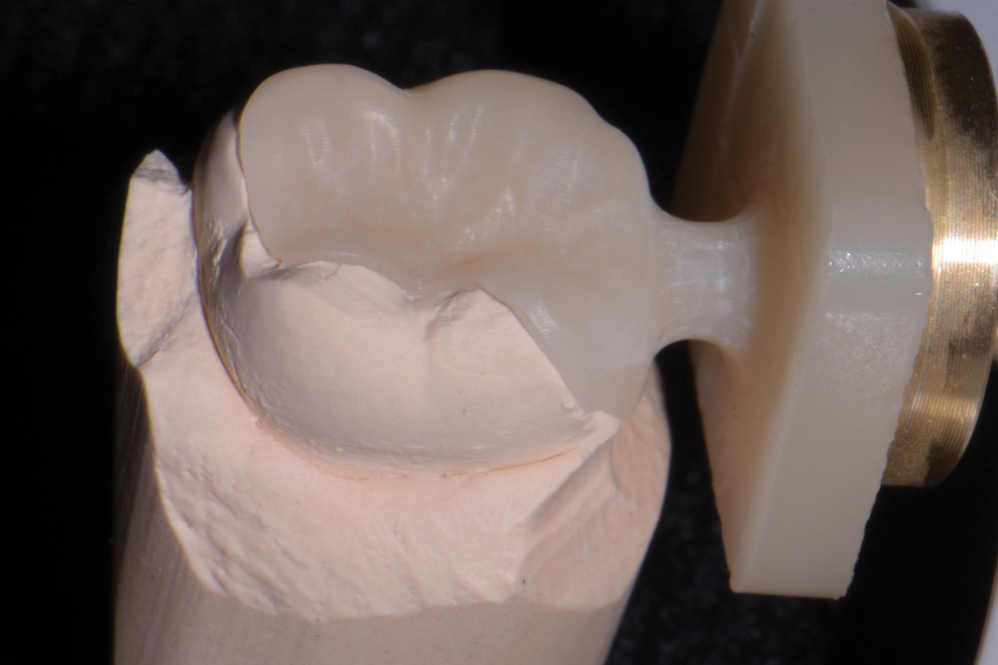 Alan Cantagalli presents an onlay restoration case using natural-looking onlays, digital scanning and CAD design.