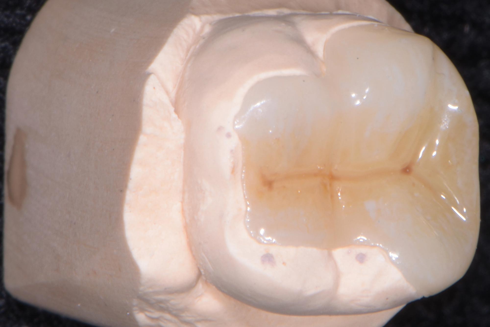 Alan Cantagalli presents an onlay restoration case using natural-looking onlays, digital scanning and CAD design.