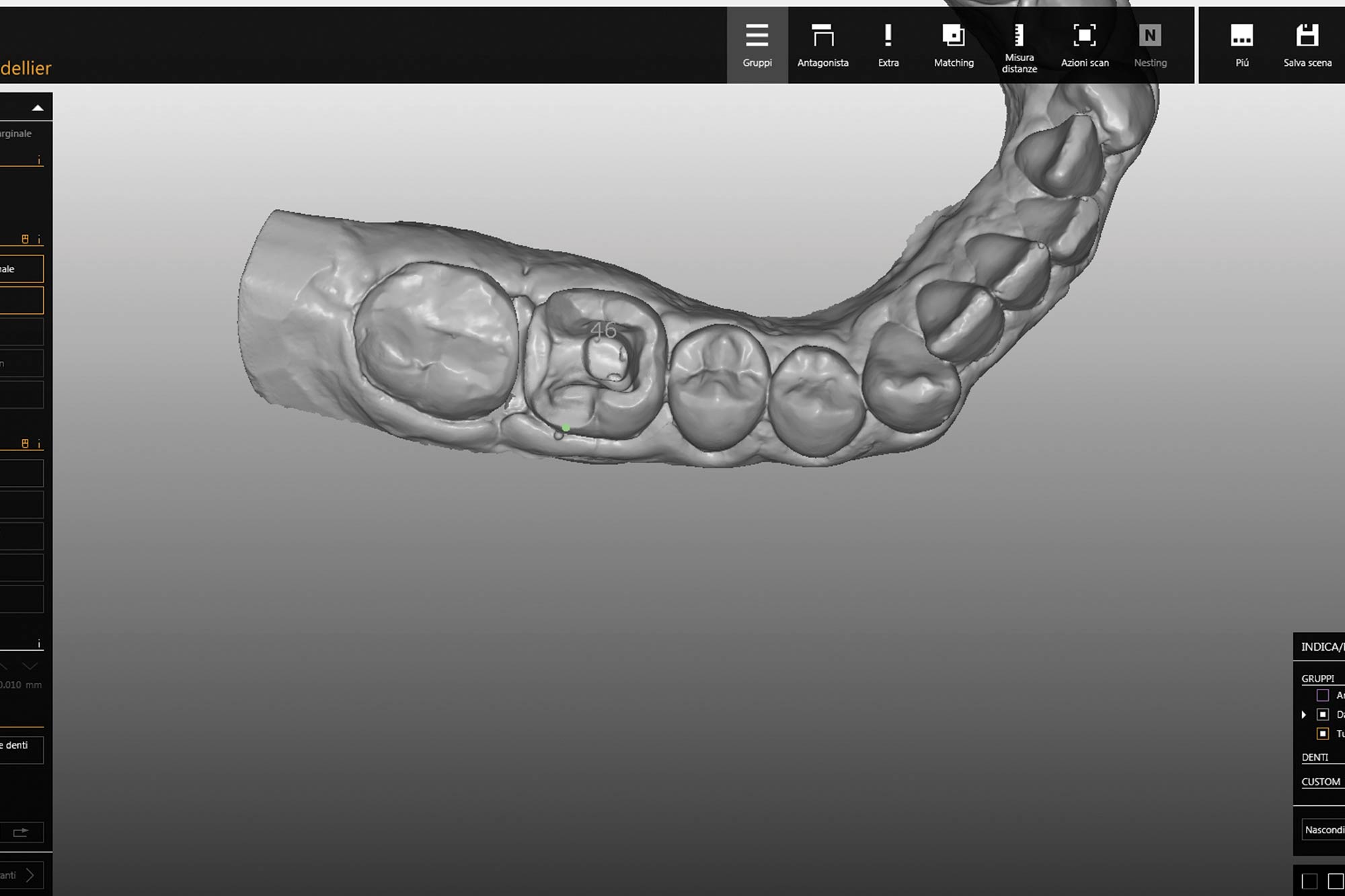 Alan Cantagalli presents an onlay restoration case using natural-looking onlays, digital scanning and CAD design.