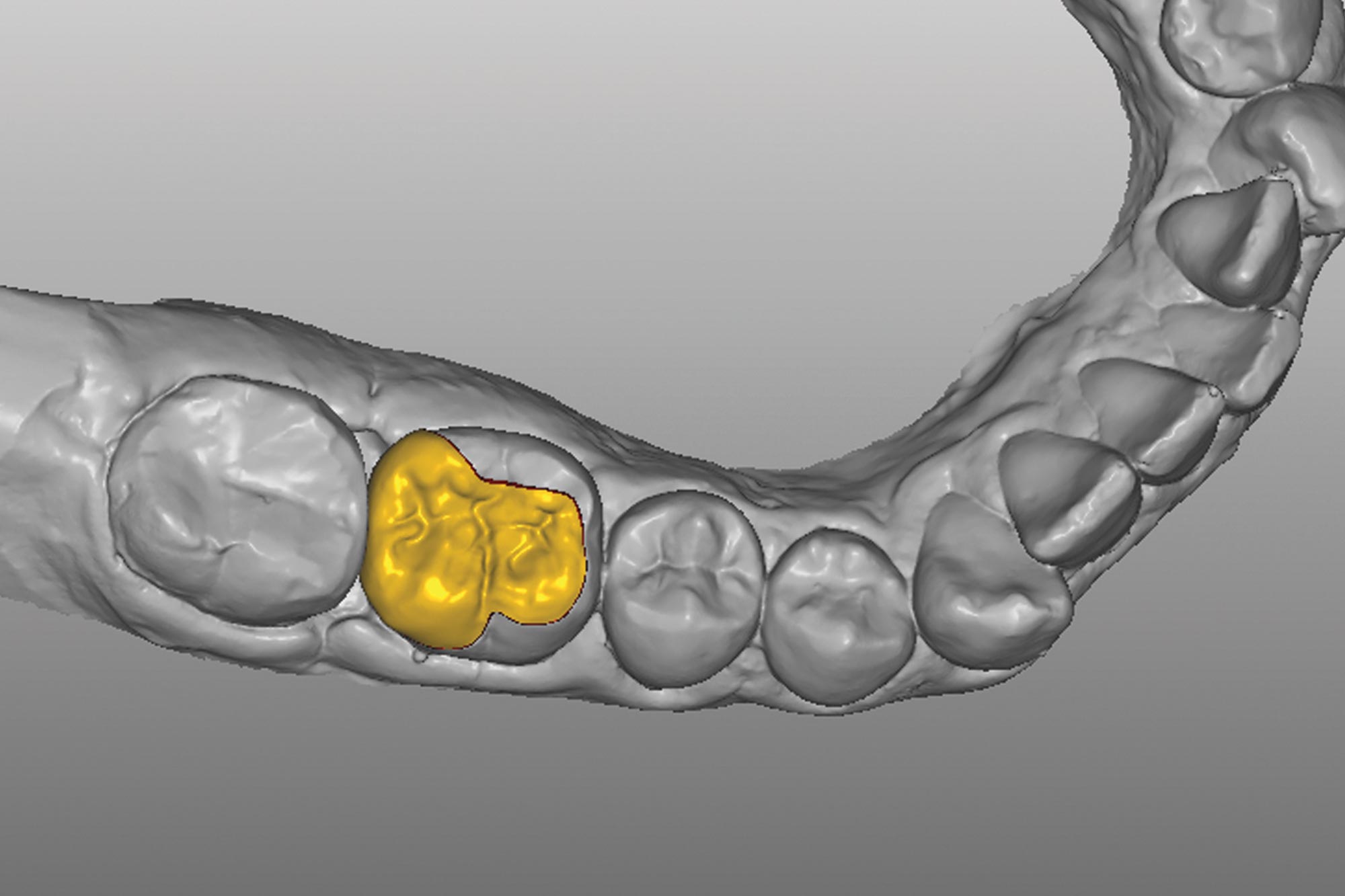 Alan Cantagalli presents an onlay restoration case using natural-looking onlays, digital scanning and CAD design.