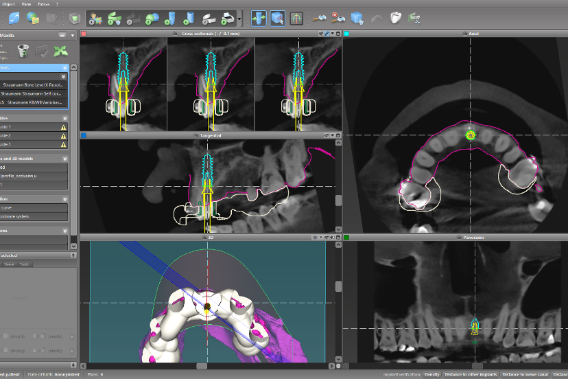 Precise virtual planning and surgical guide design using Codiagnostix