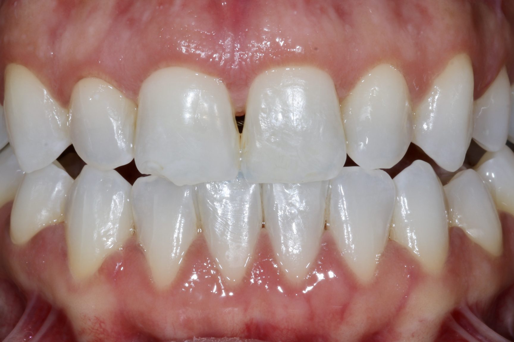 Nishan Dixit describes a minimally invasive alignment, bleaching and edge-bonding case in which the patient was ‘elated and confident’ after their smile transformation.