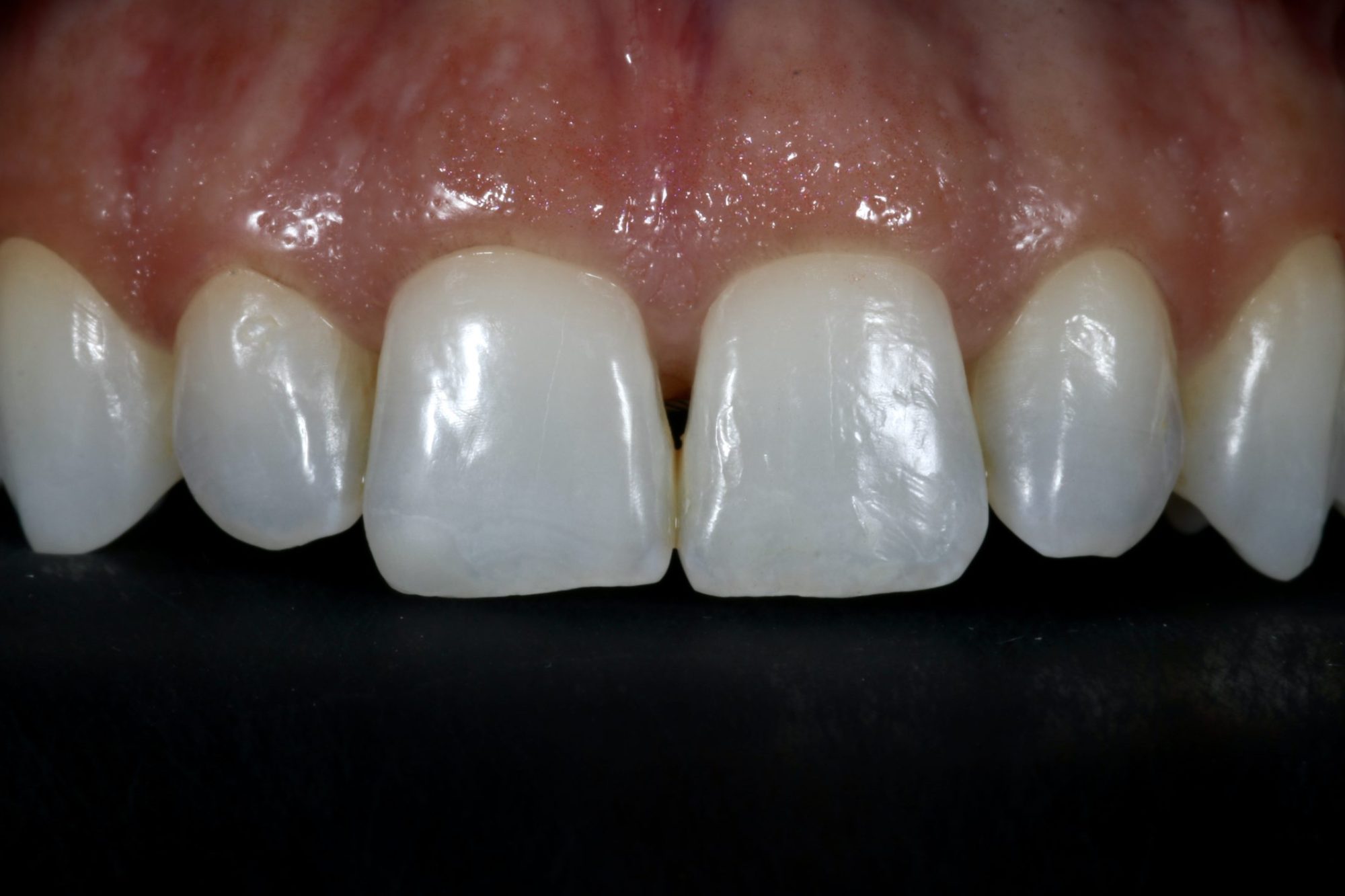 Nishan Dixit describes a minimally invasive alignment, bleaching and edge-bonding case in which the patient was ‘elated and confident’ after their smile transformation.