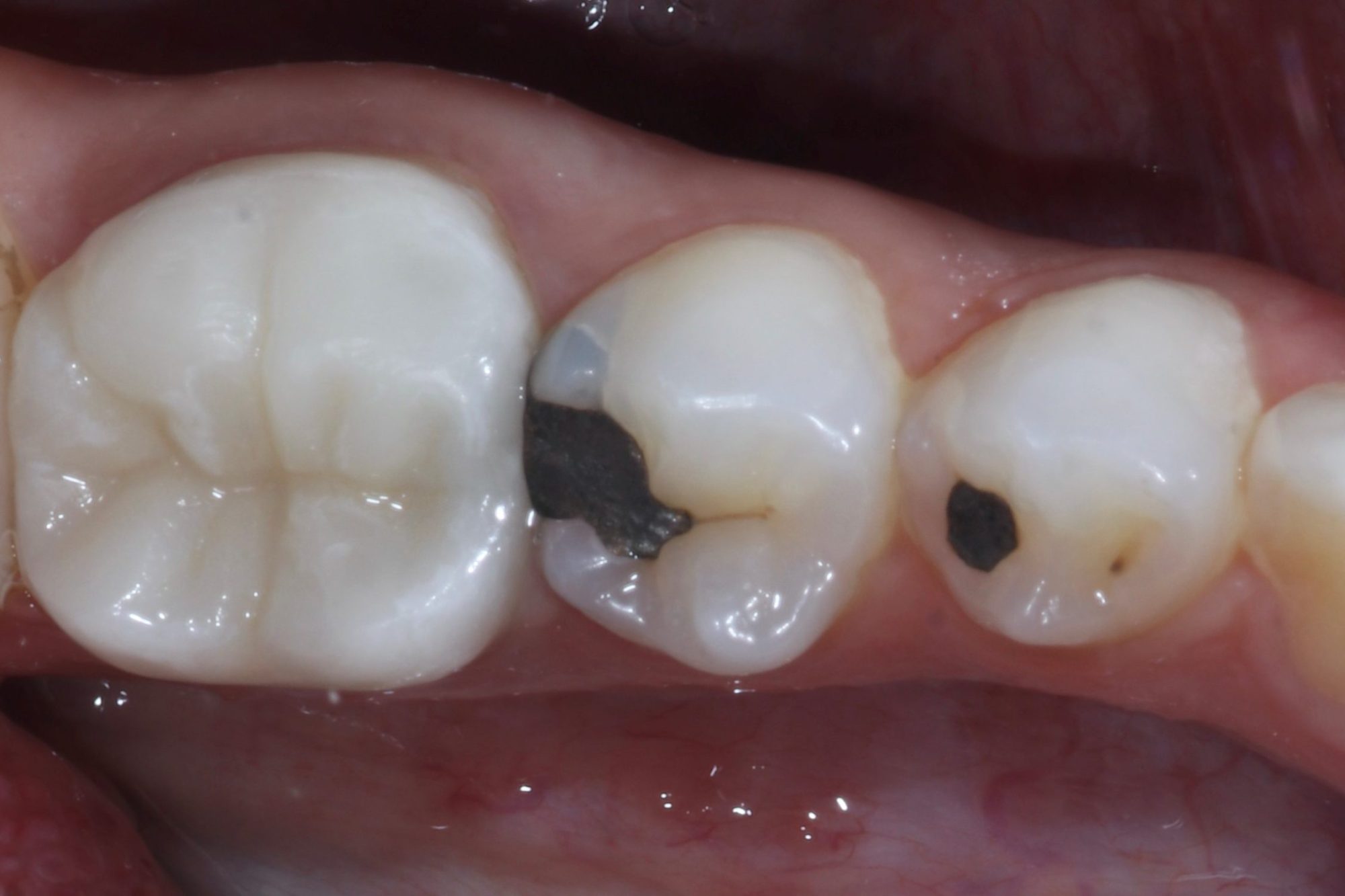 Nishan Dixit describes a minimally invasive alignment, bleaching and edge-bonding case in which the patient was ‘elated and confident’ after their smile transformation.