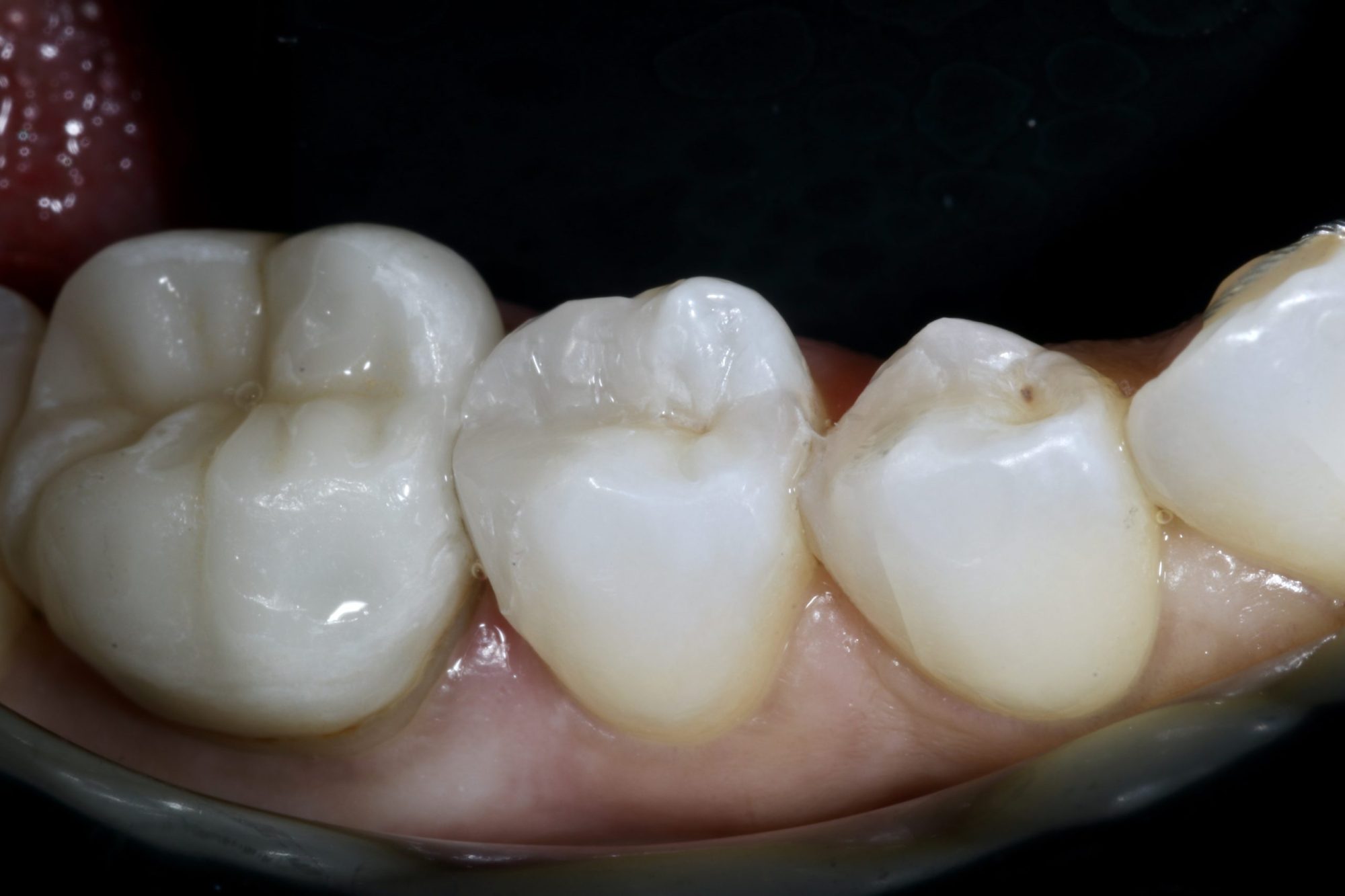 Nishan Dixit describes a minimally invasive alignment, bleaching and edge-bonding case in which the patient was ‘elated and confident’ after their smile transformation.