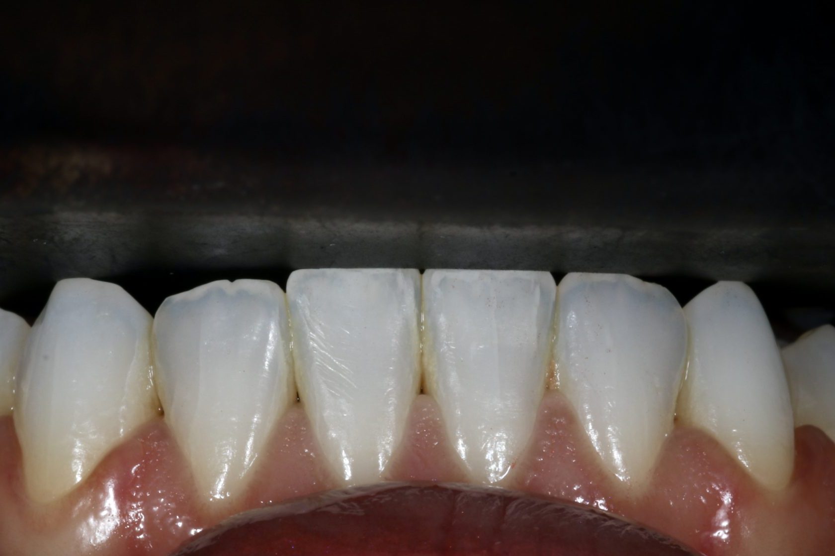 Nishan Dixit describes a minimally invasive alignment, bleaching and edge-bonding case in which the patient was ‘elated and confident’ after their smile transformation.