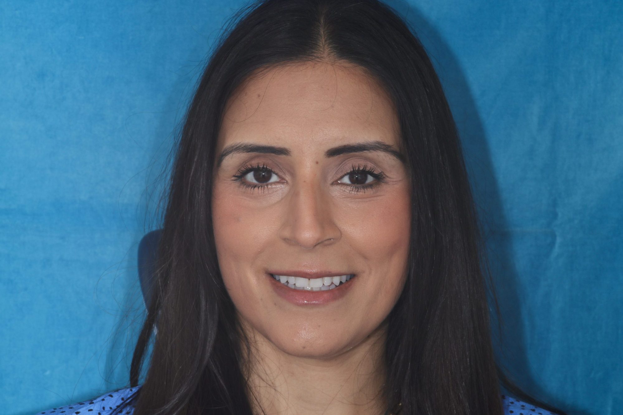 Nishan Dixit describes a minimally invasive alignment, bleaching and edge-bonding case in which the patient was ‘elated and confident’ after their smile transformation.