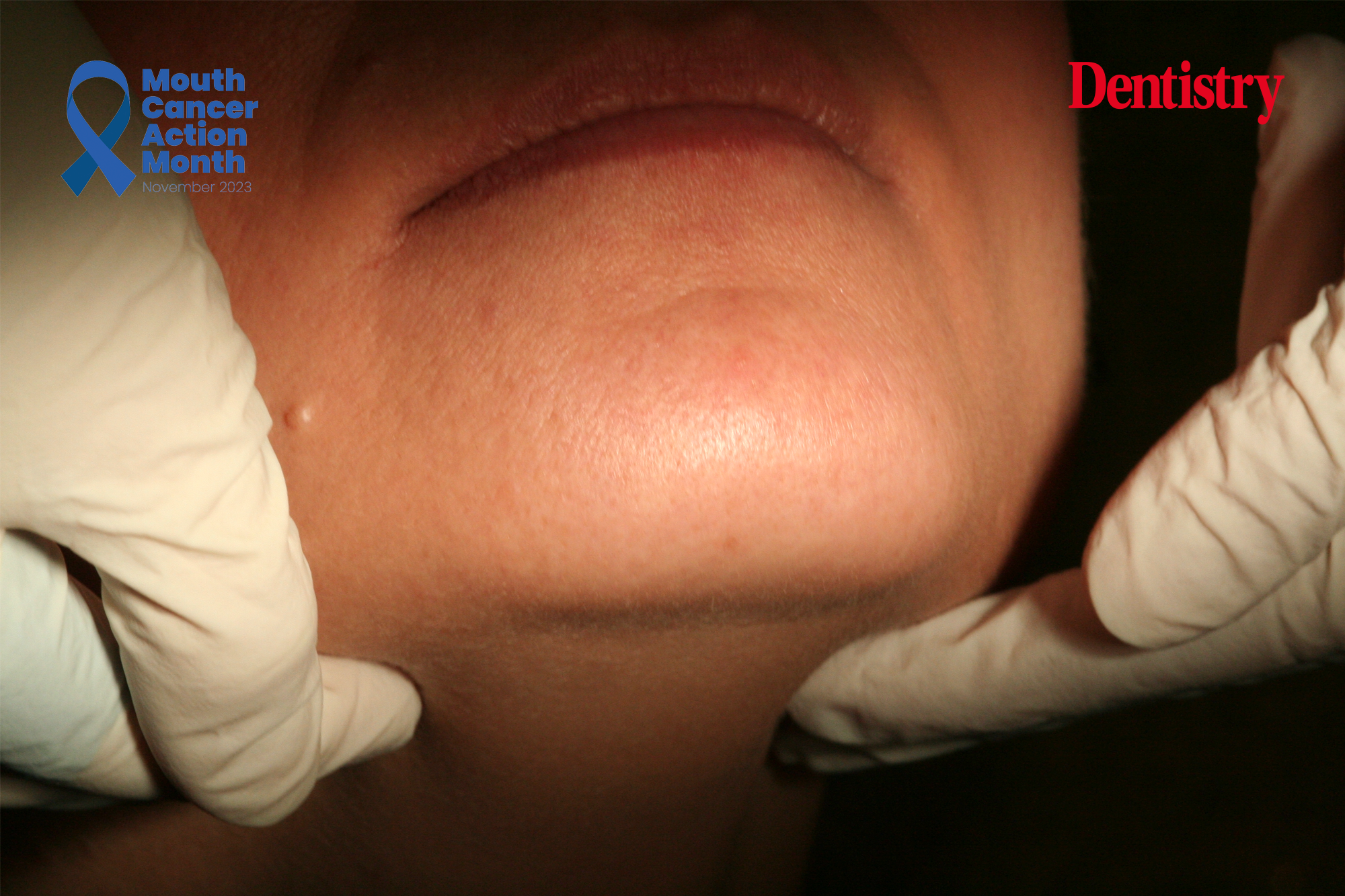 how to perform a mouth cancer screening