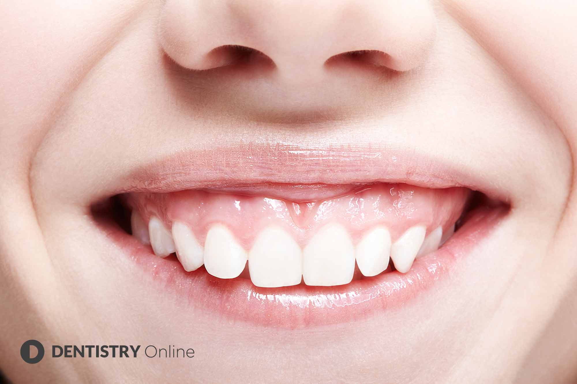 gummy smile