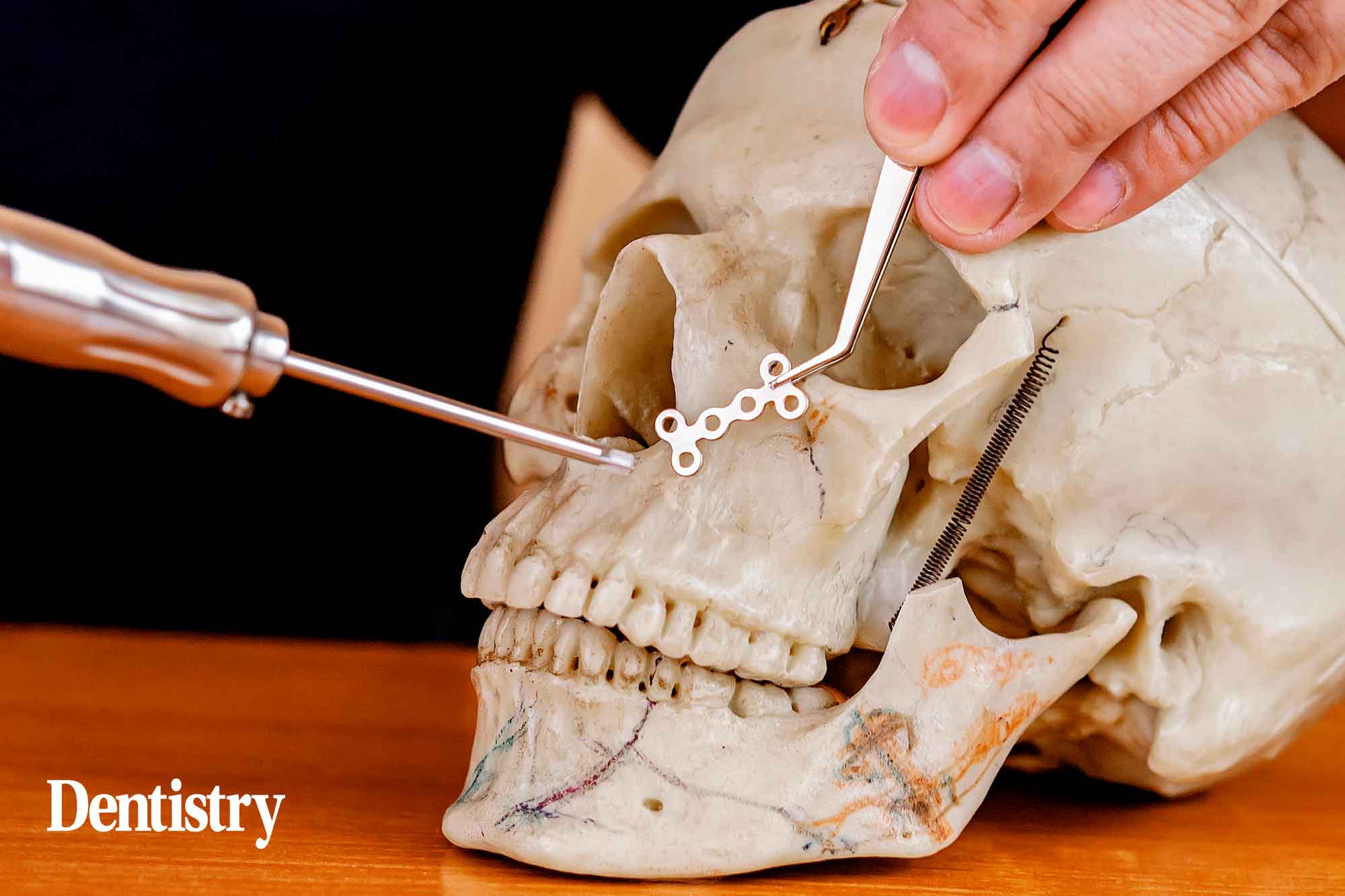 implant surgery
