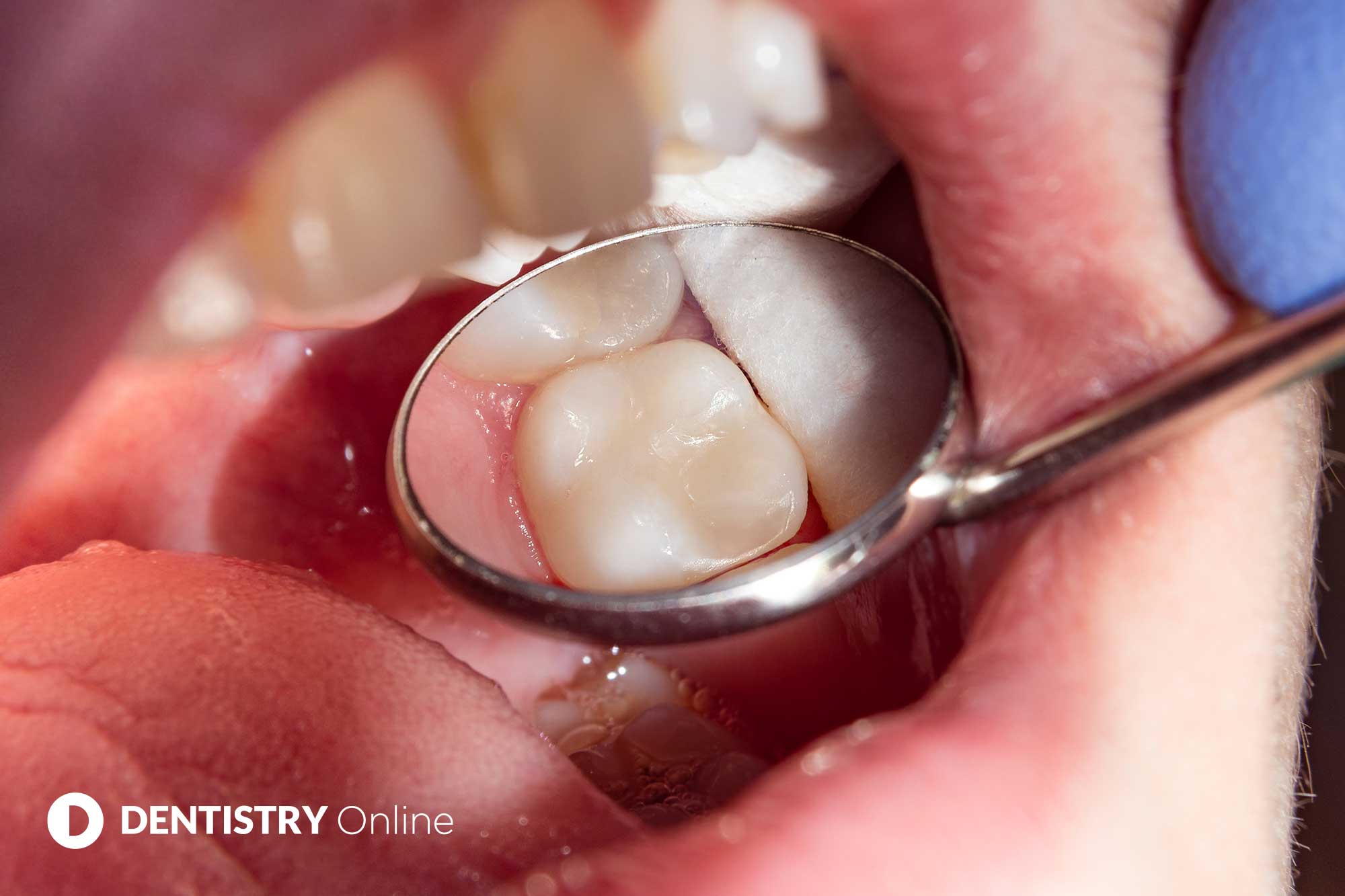 molar root canal treatment