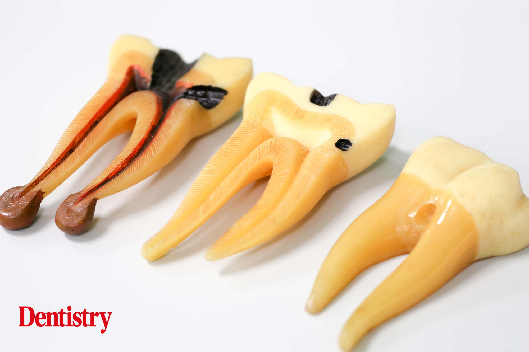 root canal