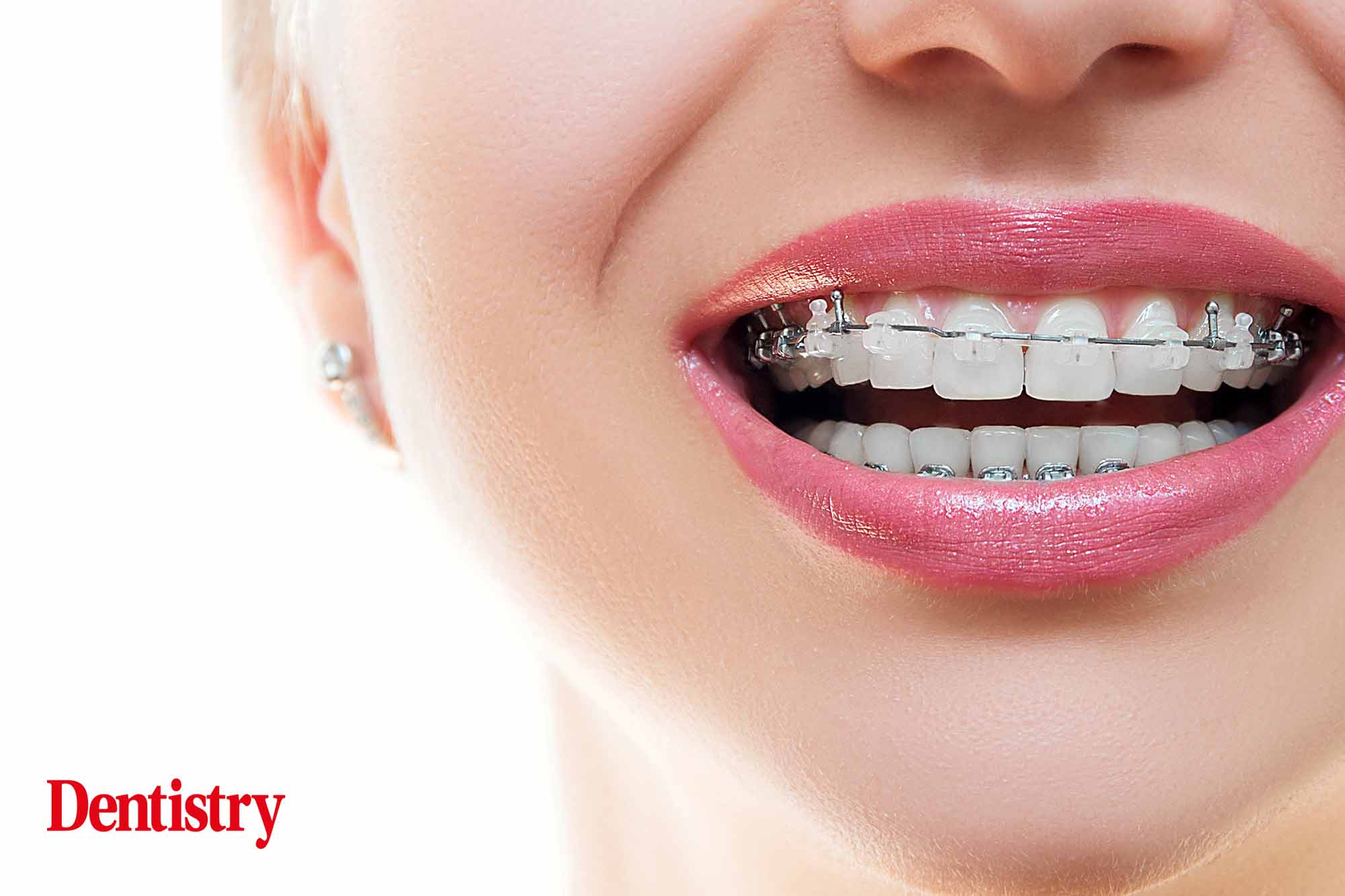 adult orthodontics