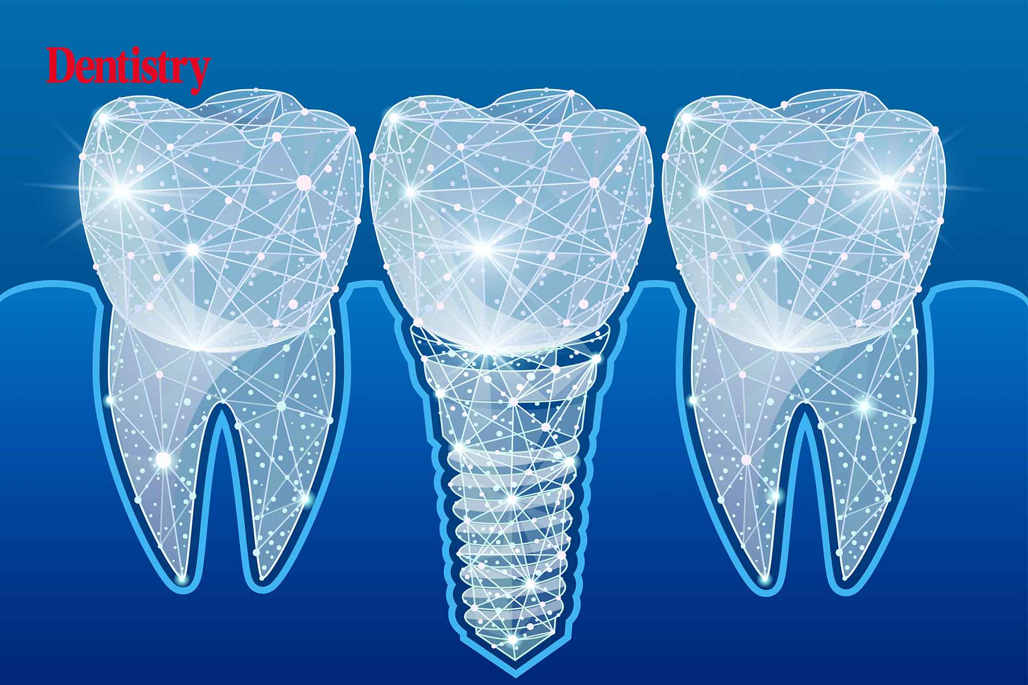 digital implant workflow
