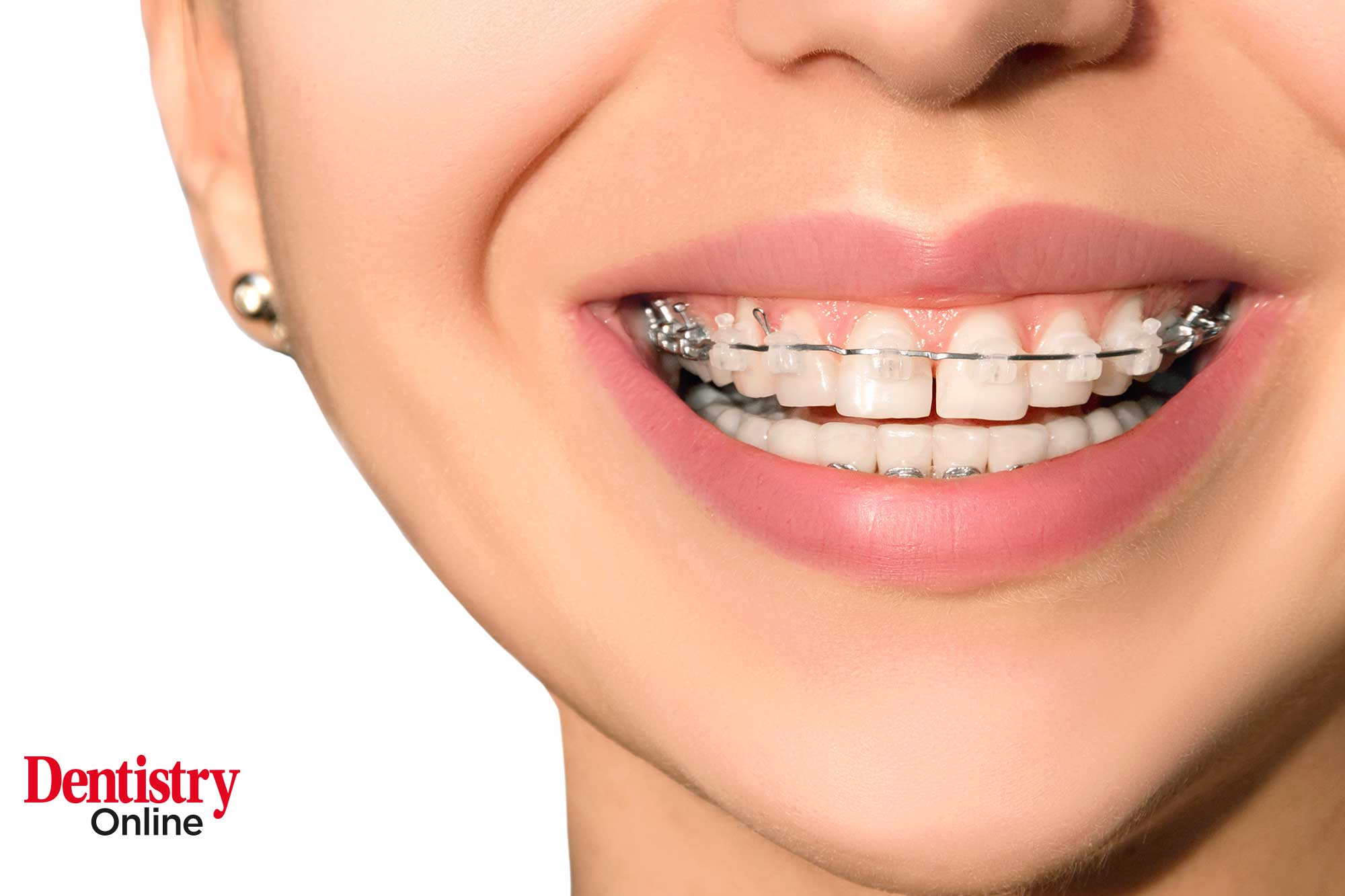 orthodontic treatment