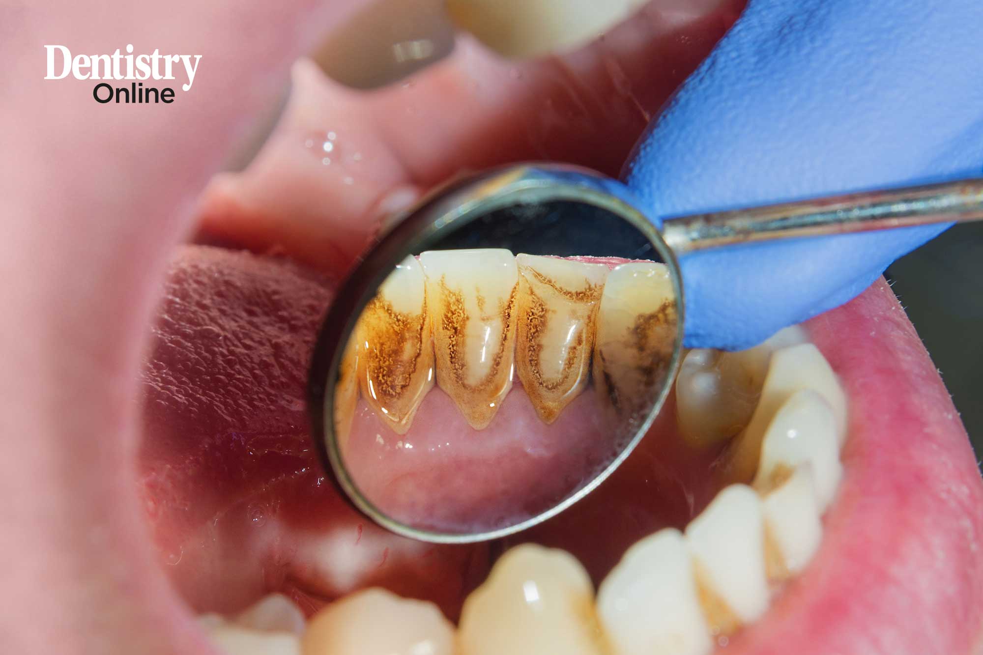 Adults suffering from periodontitis can transmit the disease to their children, it has been found