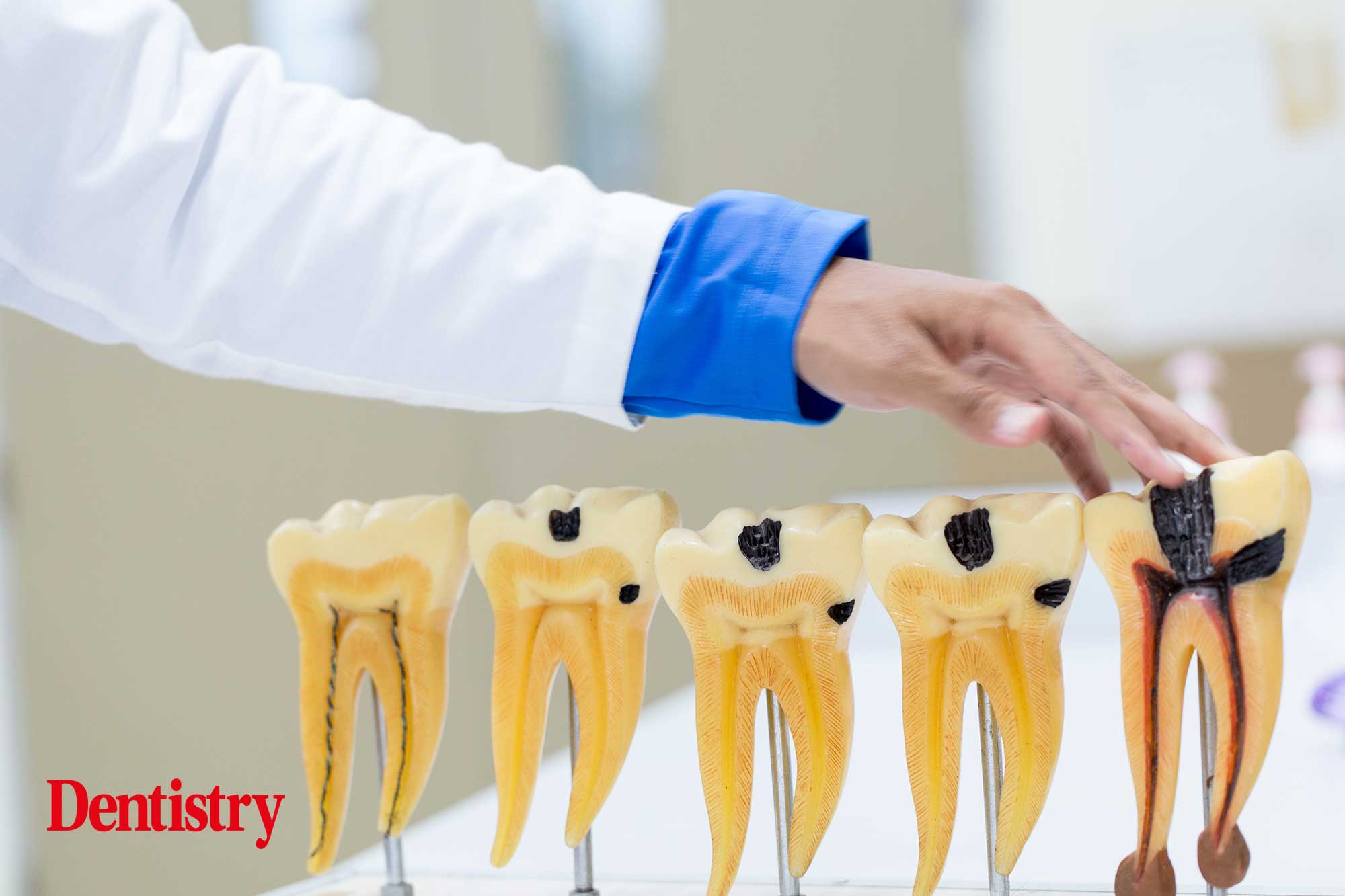root canal or implant