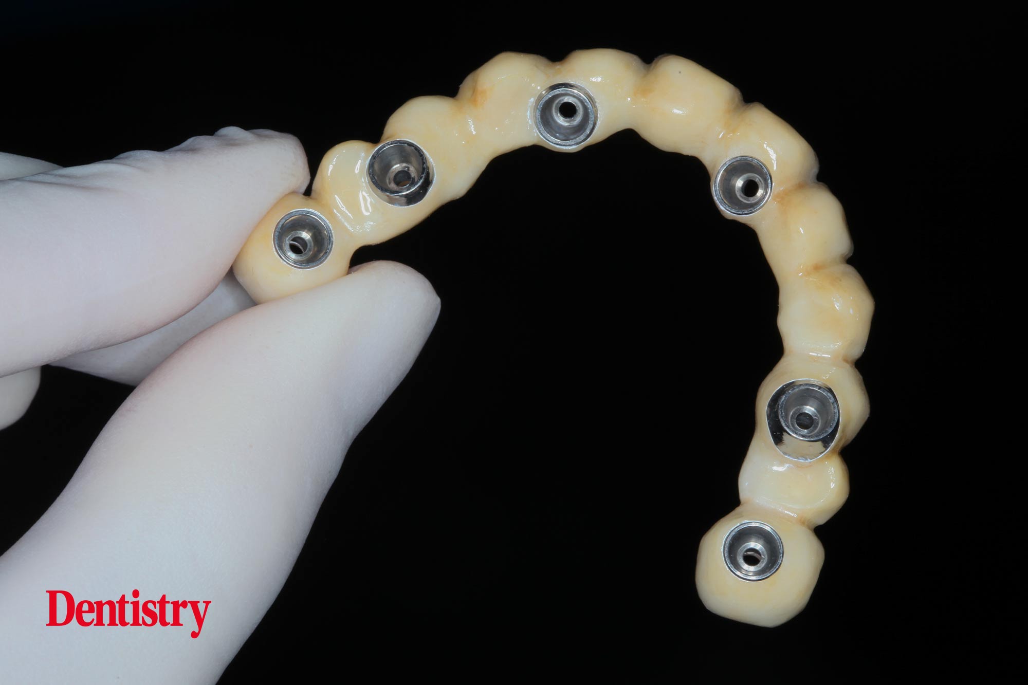 implant rehabilitation 