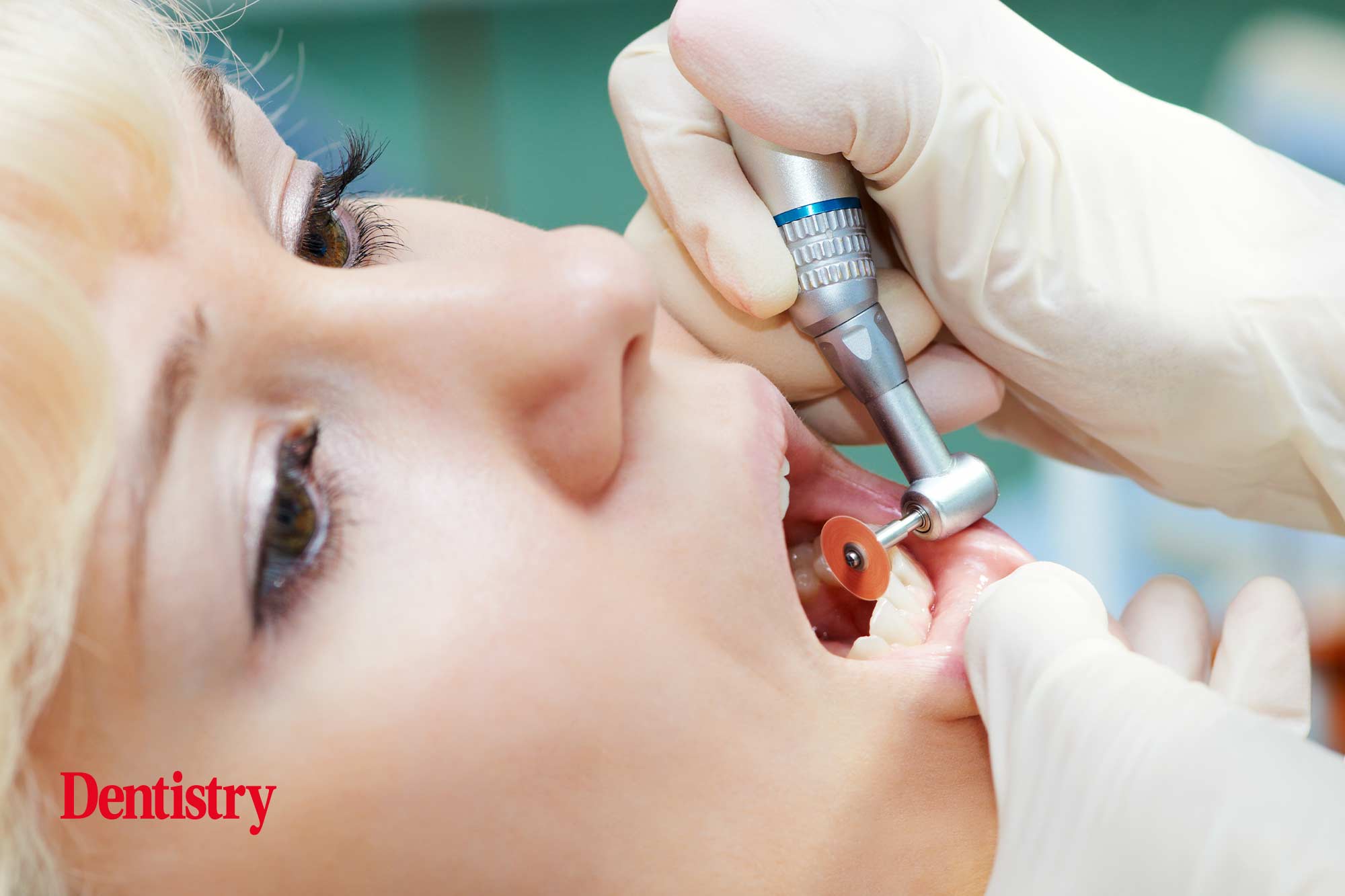 composite restorations