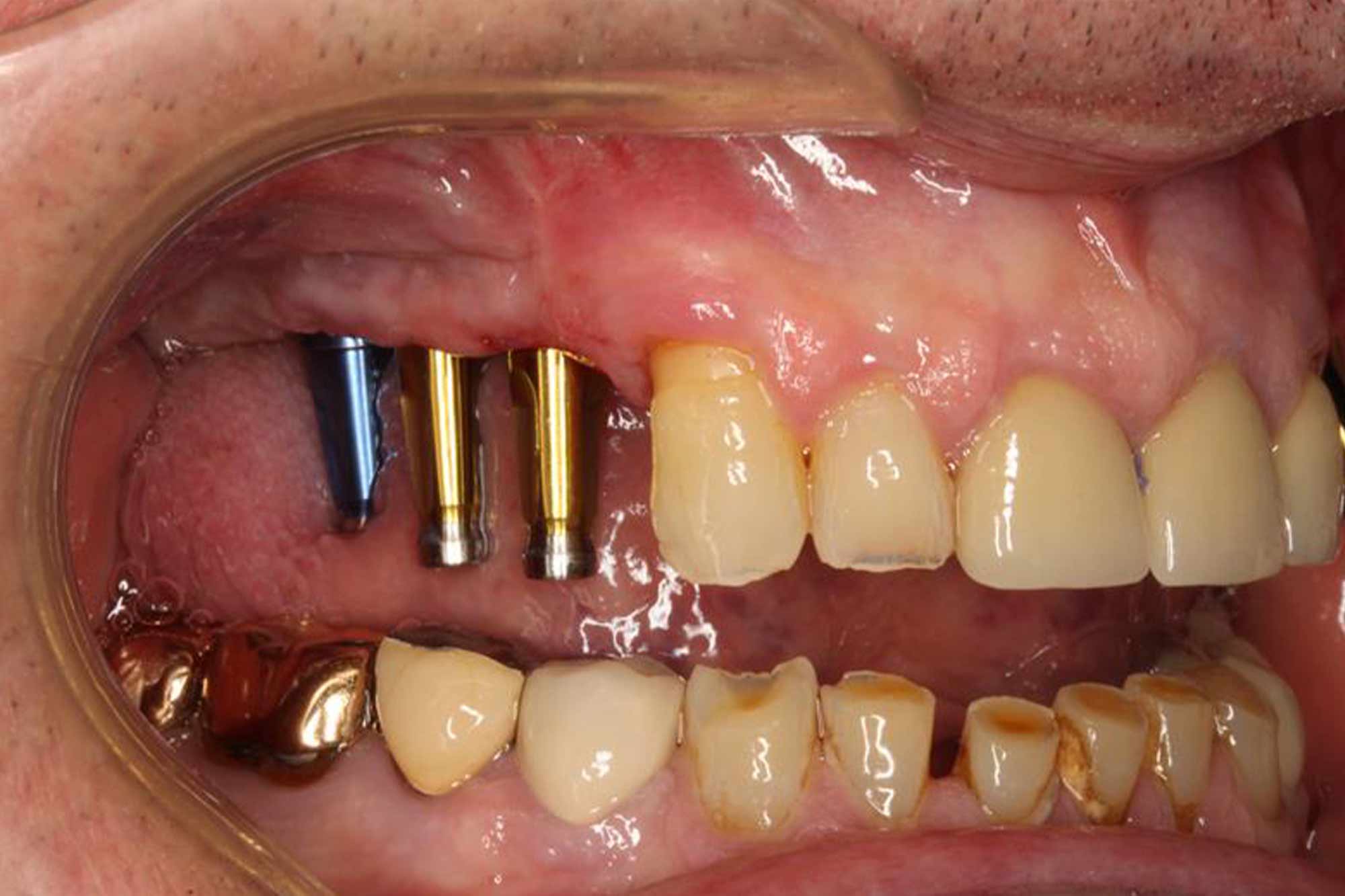 impressions for implants