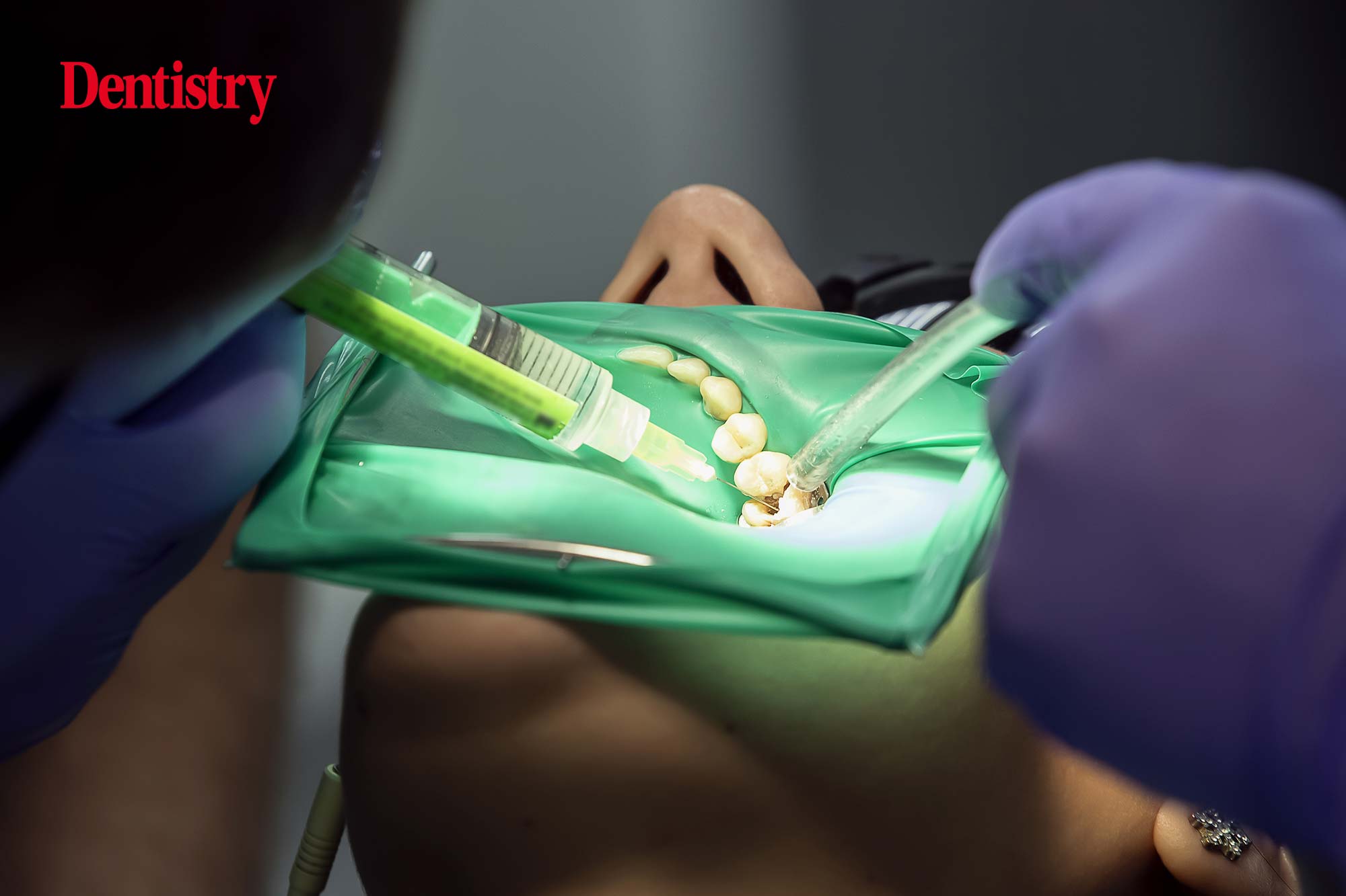 root canal