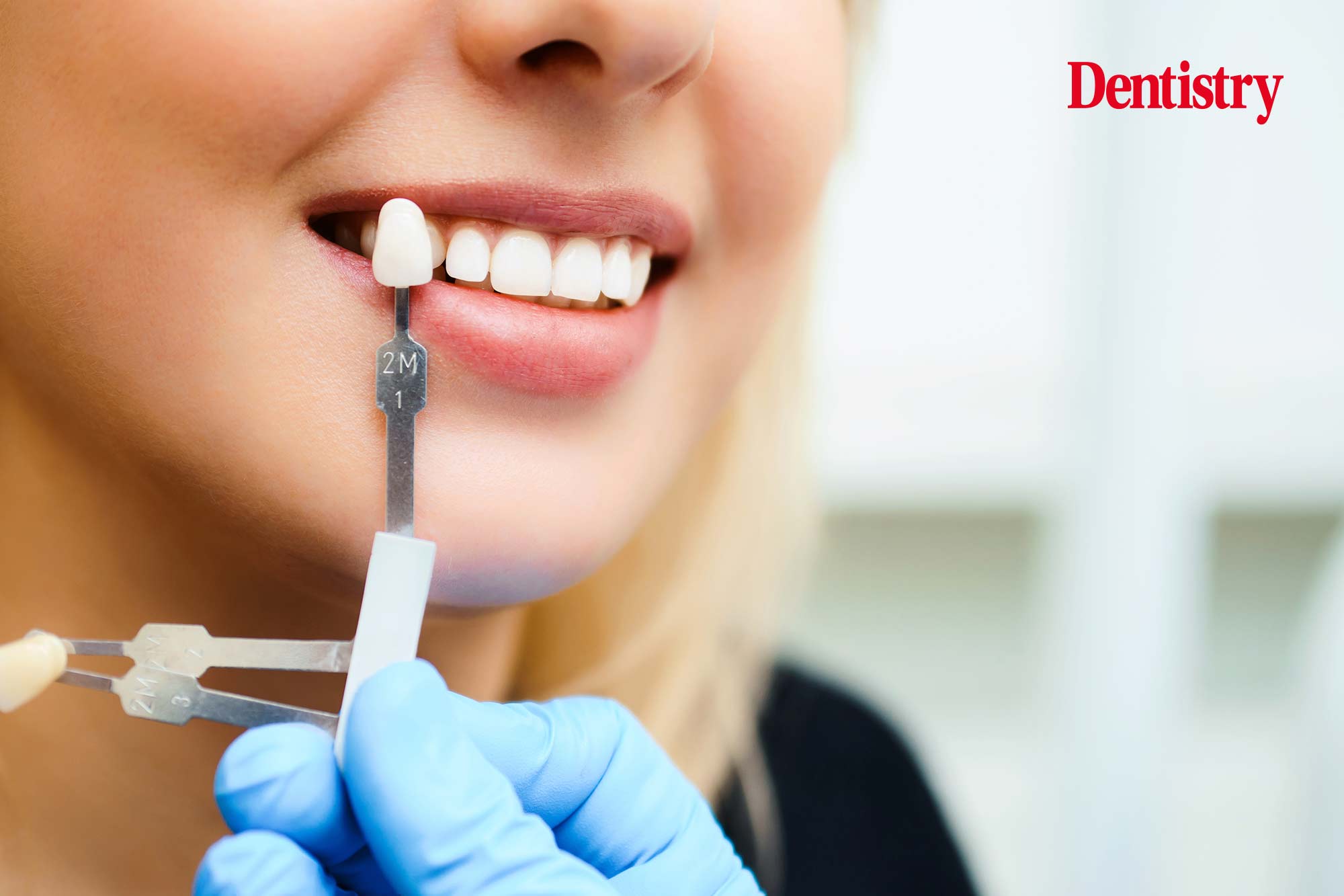 Tips for shade matching indirect restorations