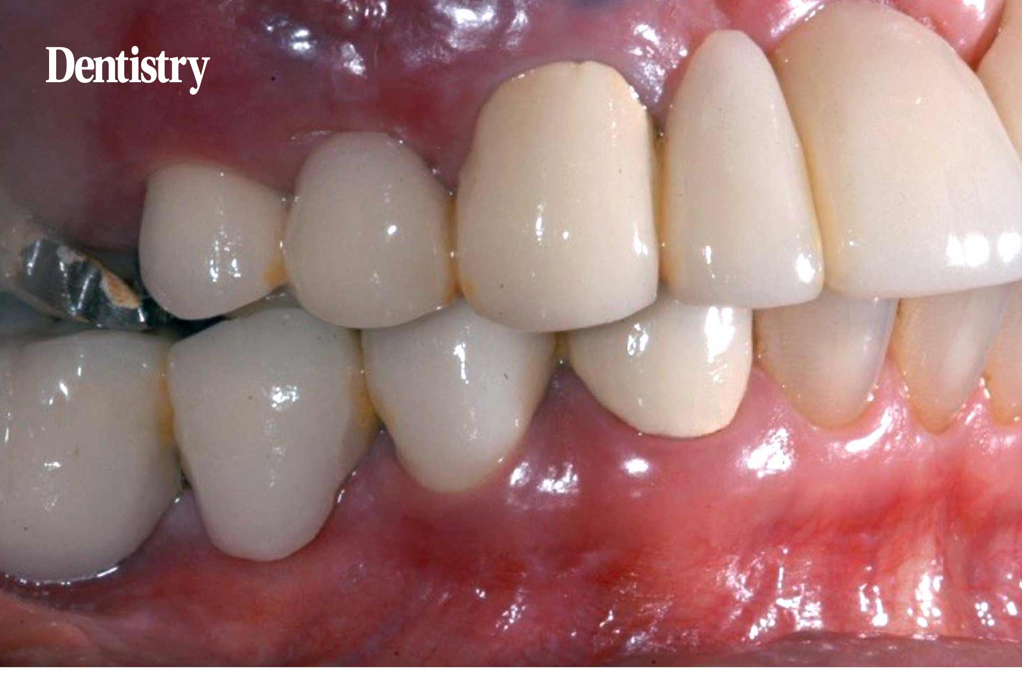 implant placement