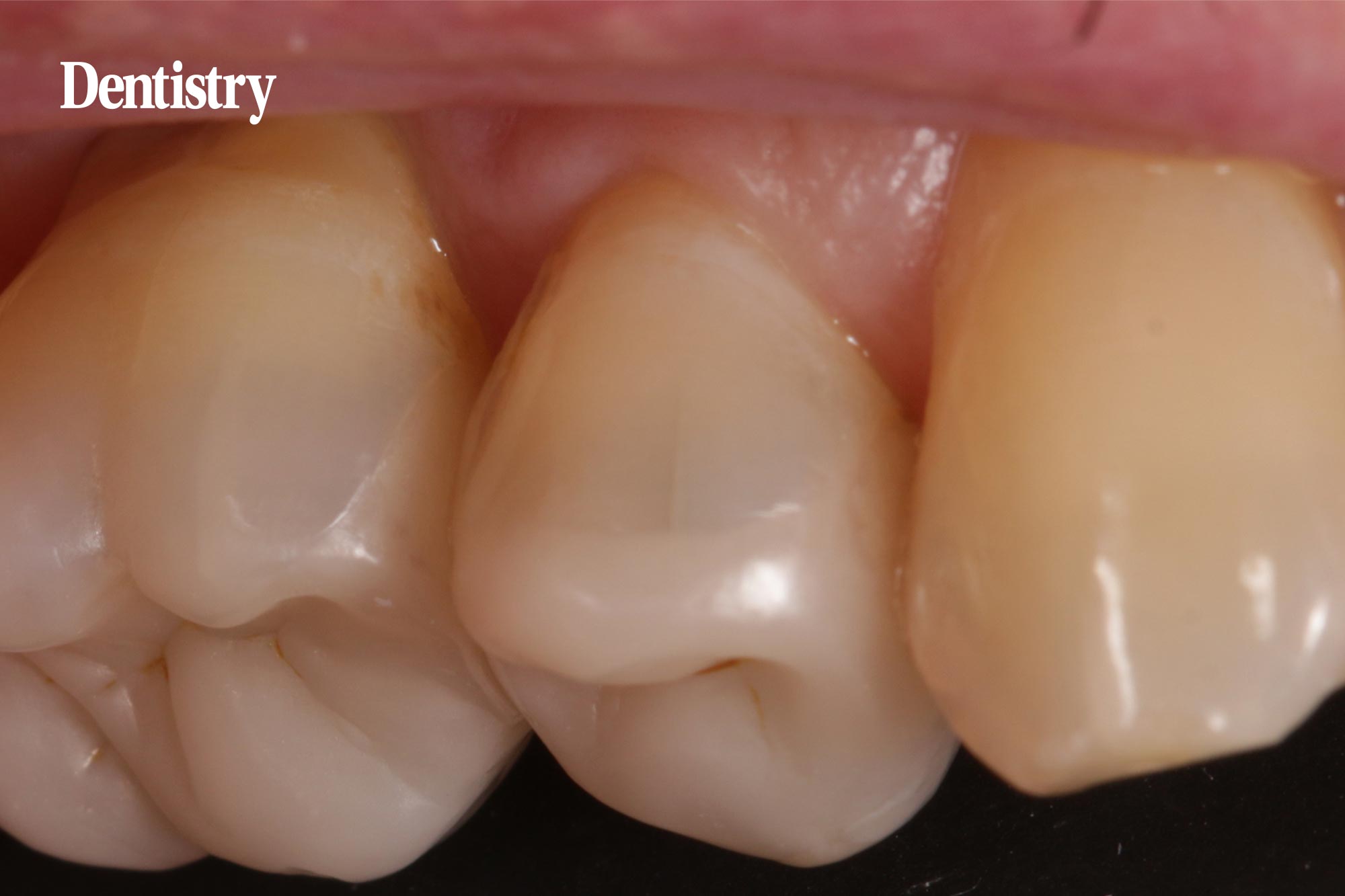 composite bonding