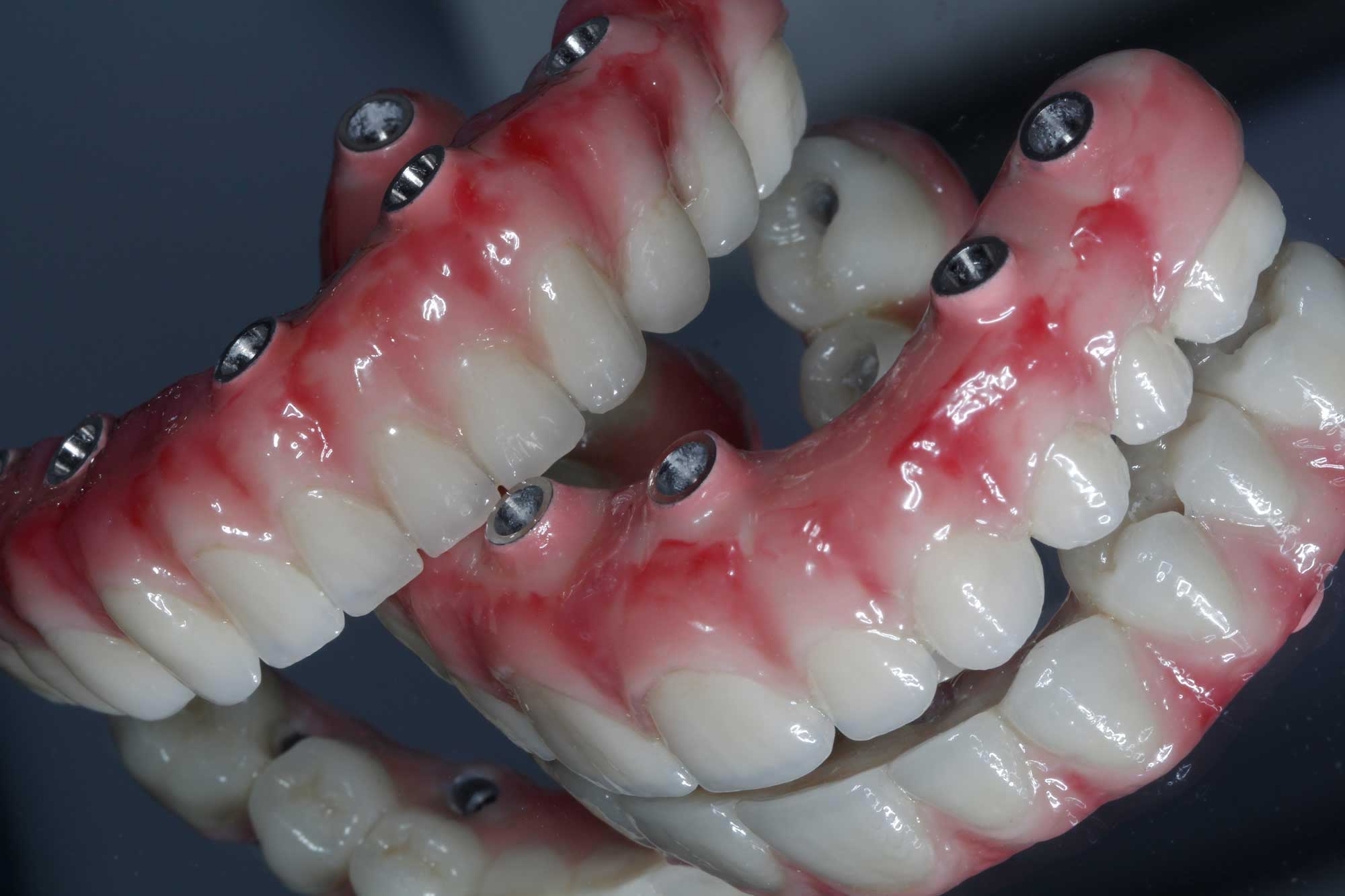 implant