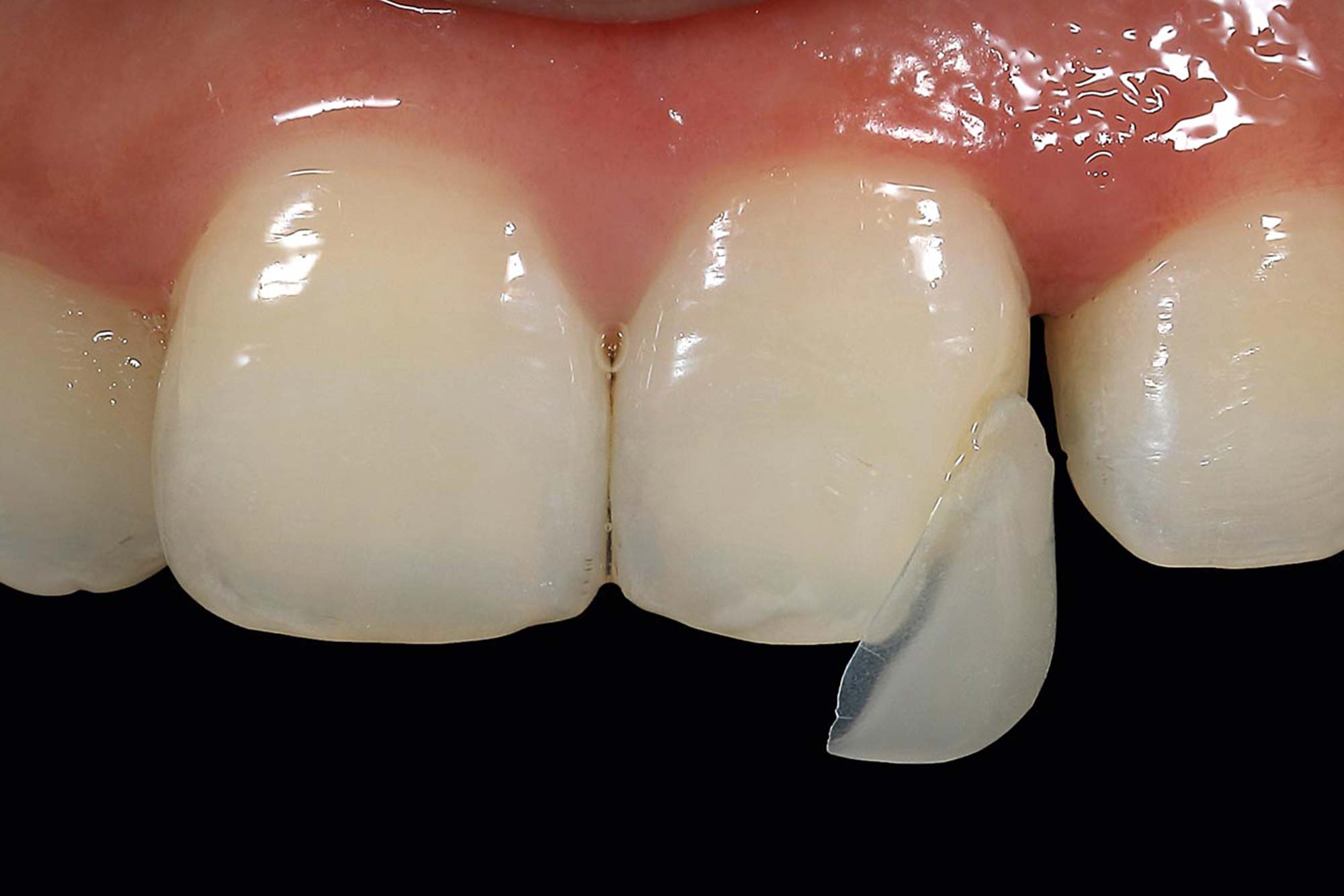 minimally invasive