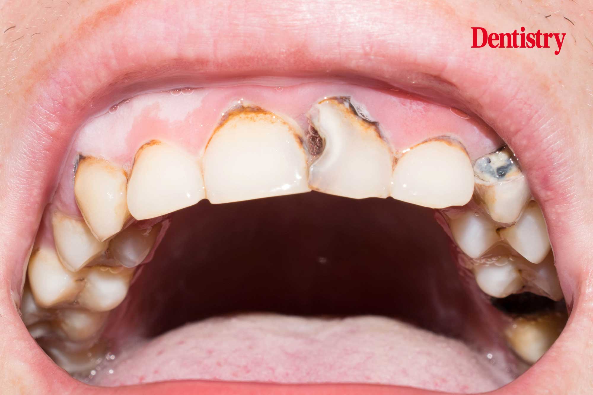 dental caries