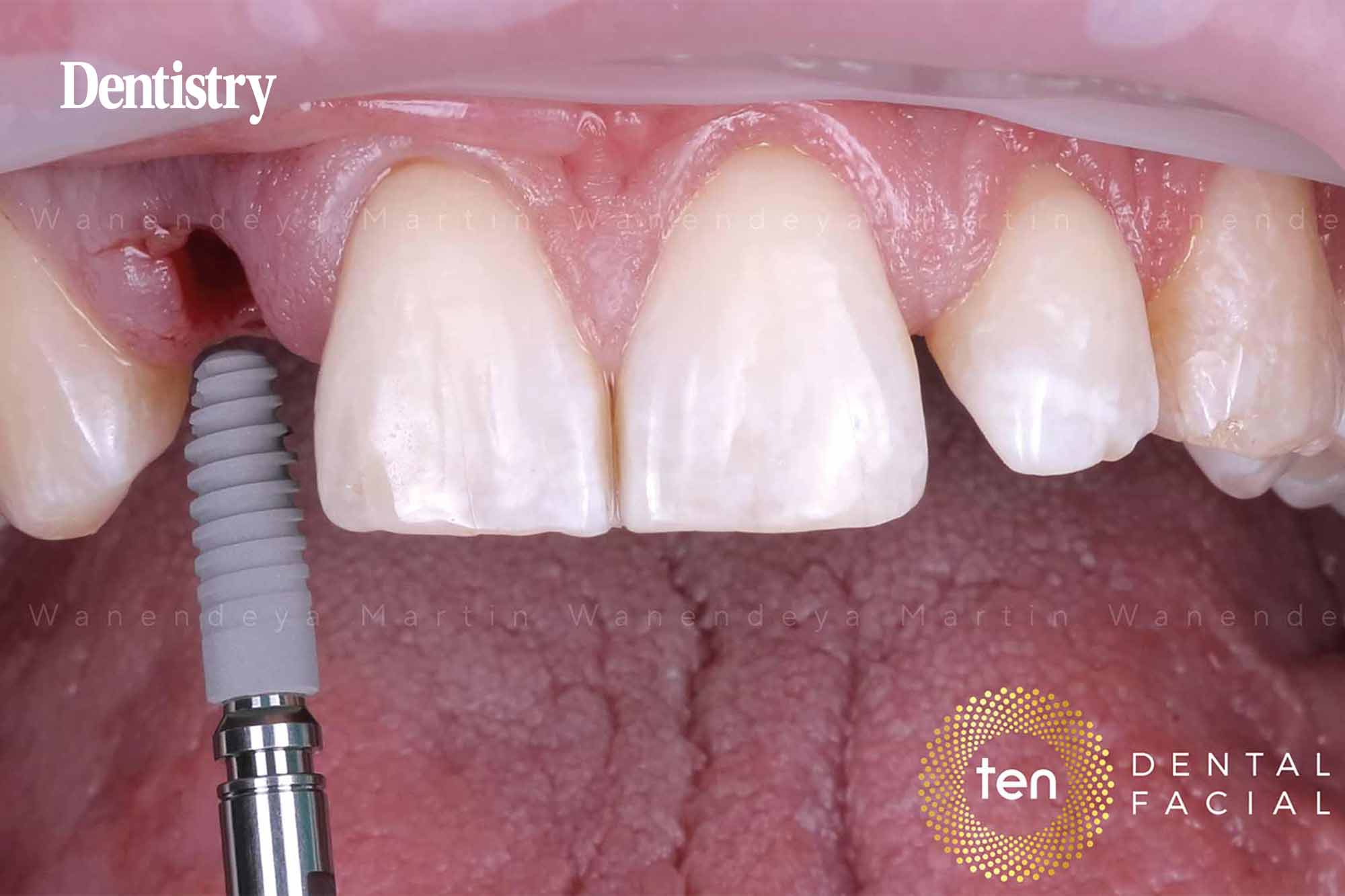 implant restoration