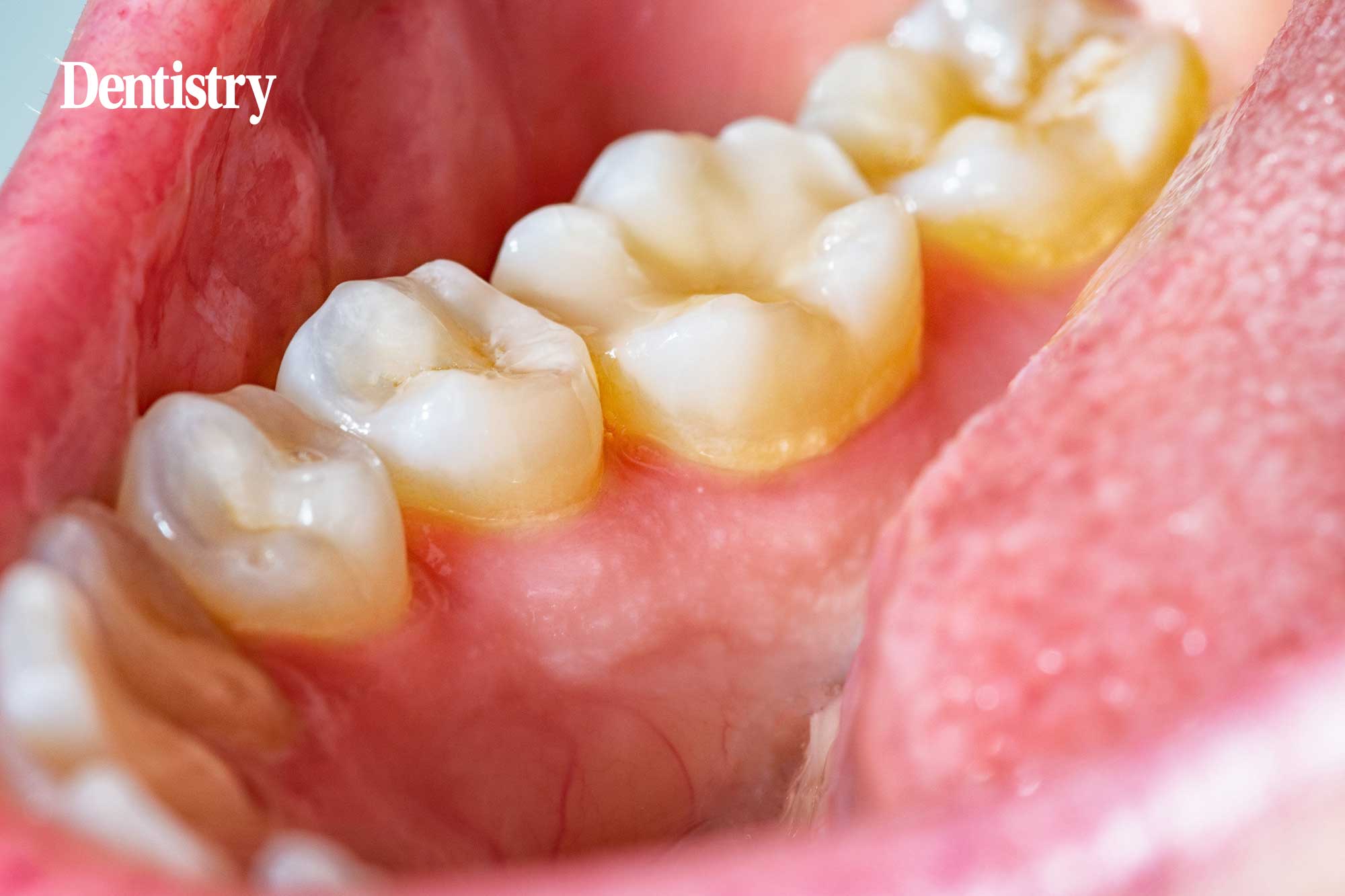 reducing plaque