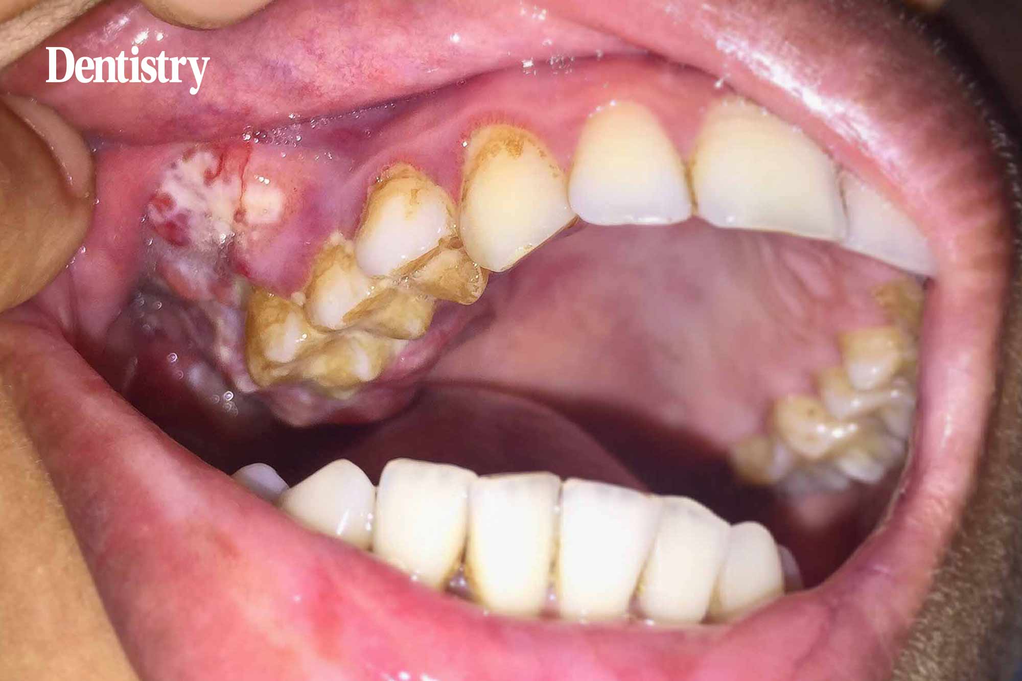 oral cancer