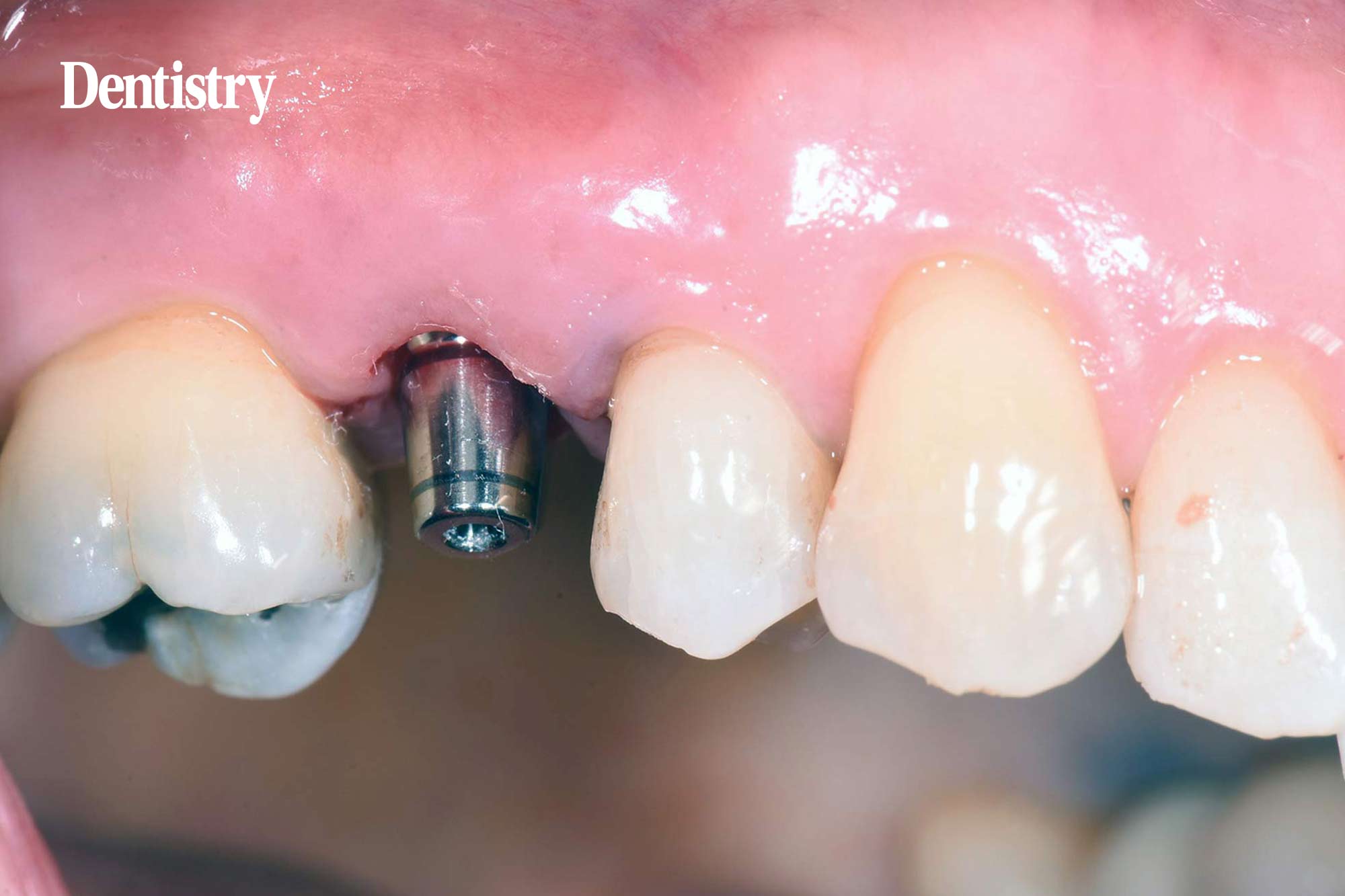 implant restoration