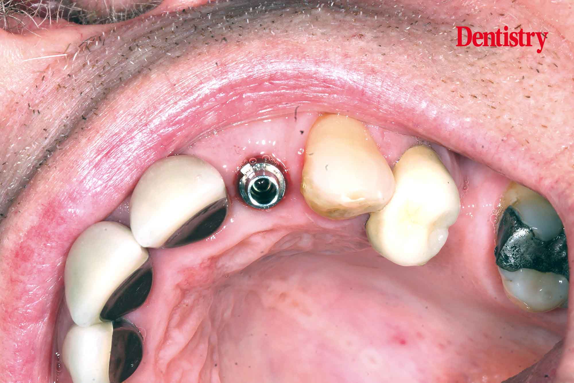 partial extraction therapy