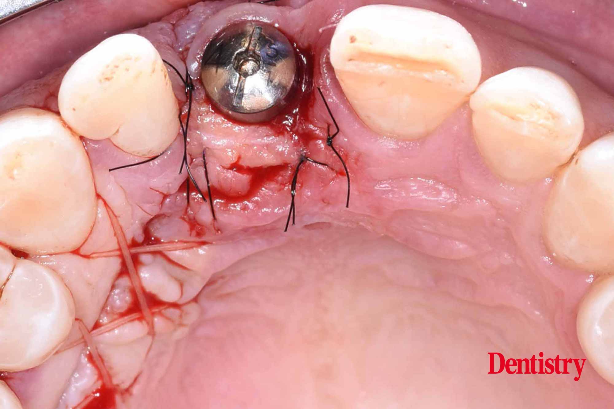 implant treatment techniques