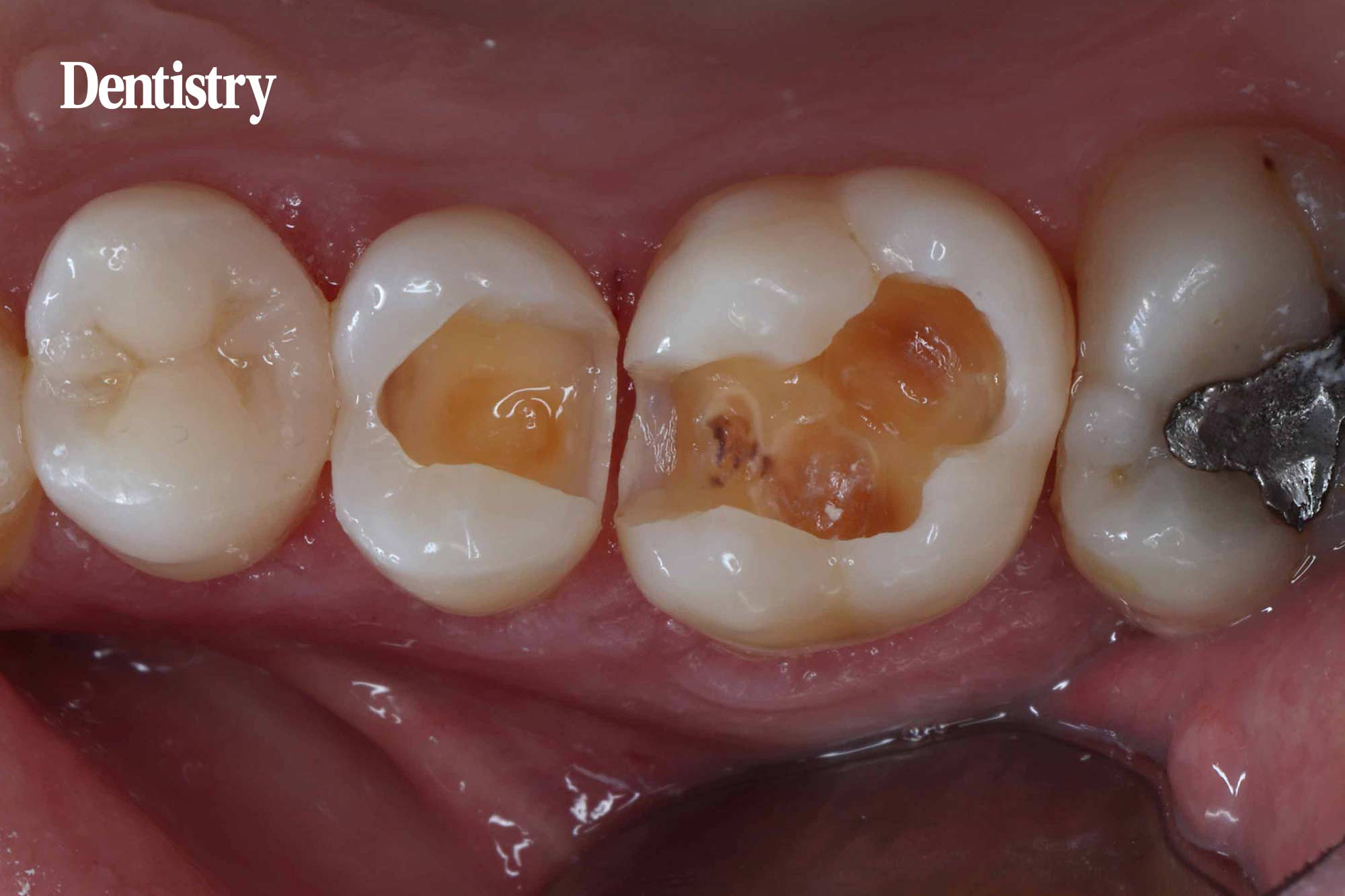 caries