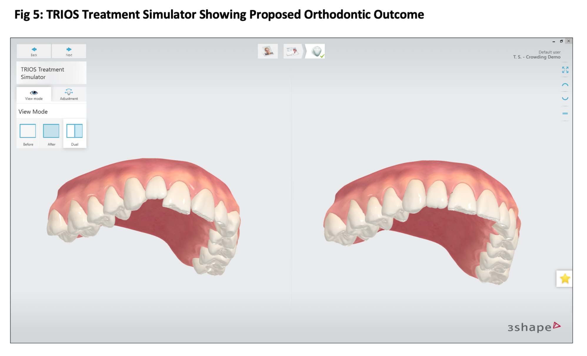 intraoral scanner