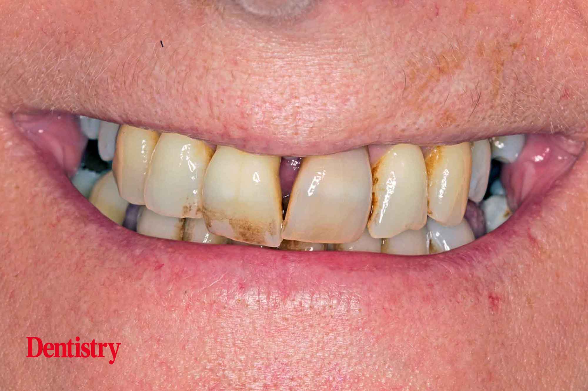 Implants and periodontitis
