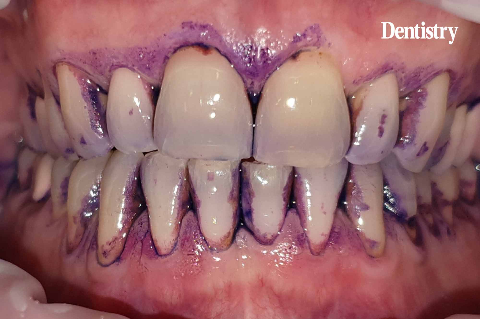 guided biofilm therapy