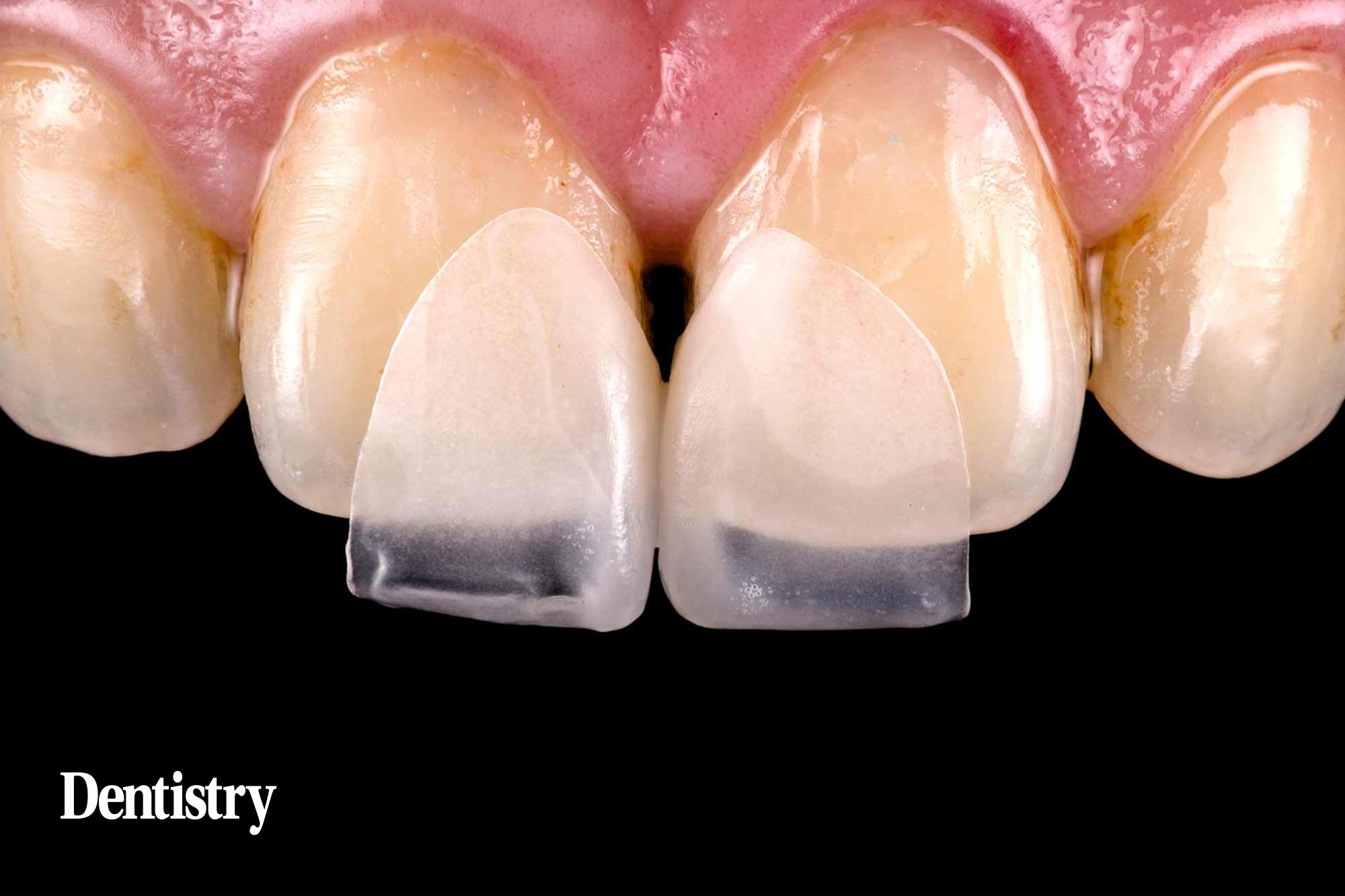 diastema in a digital workflow