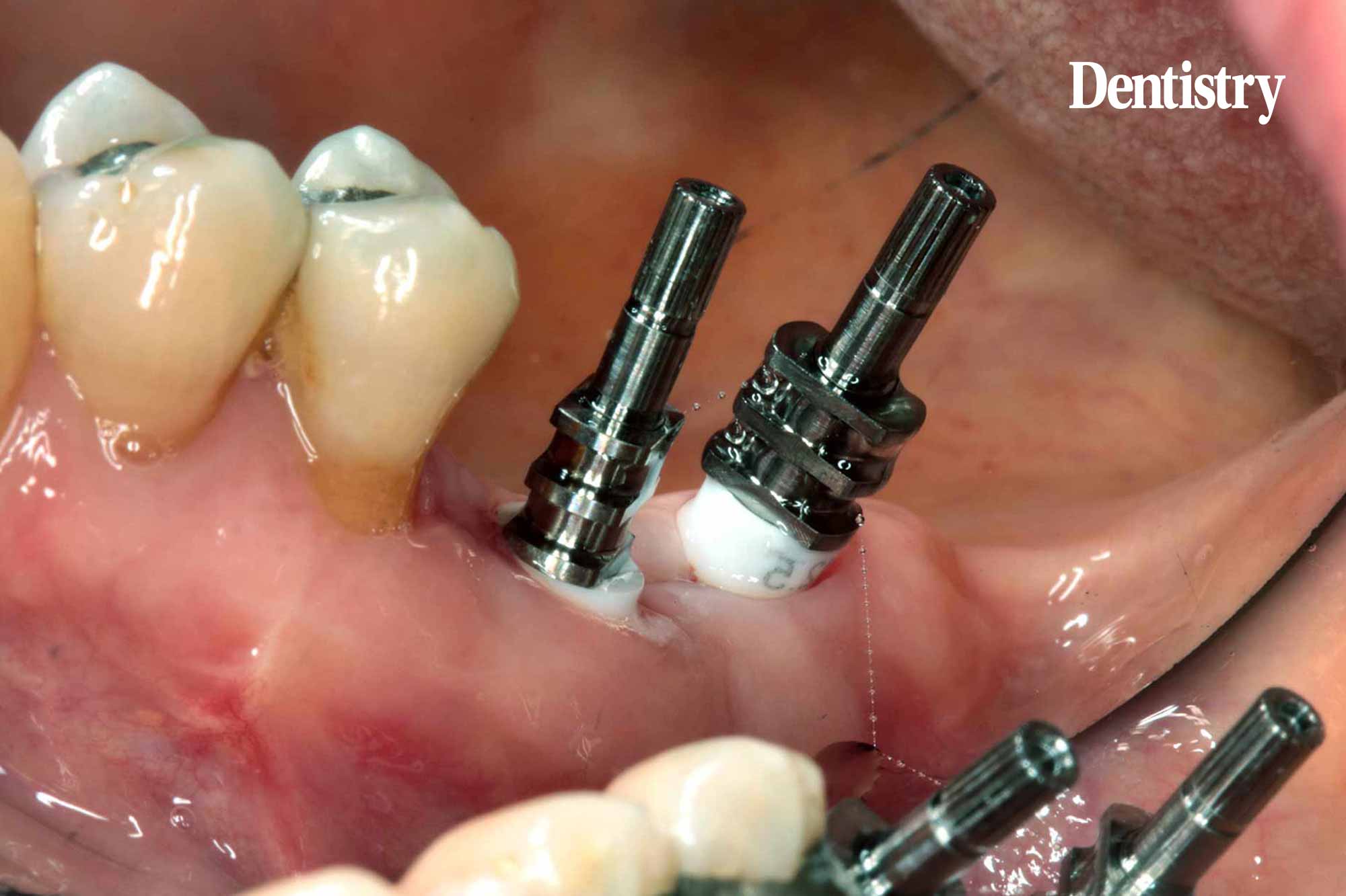 implant placement primary stability
