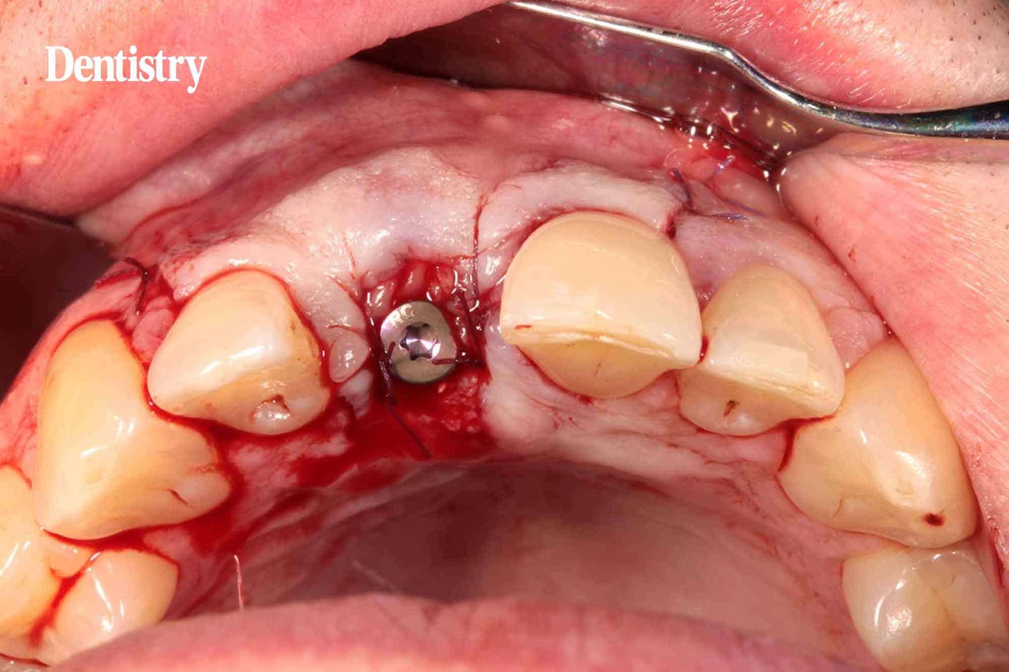 implant placement