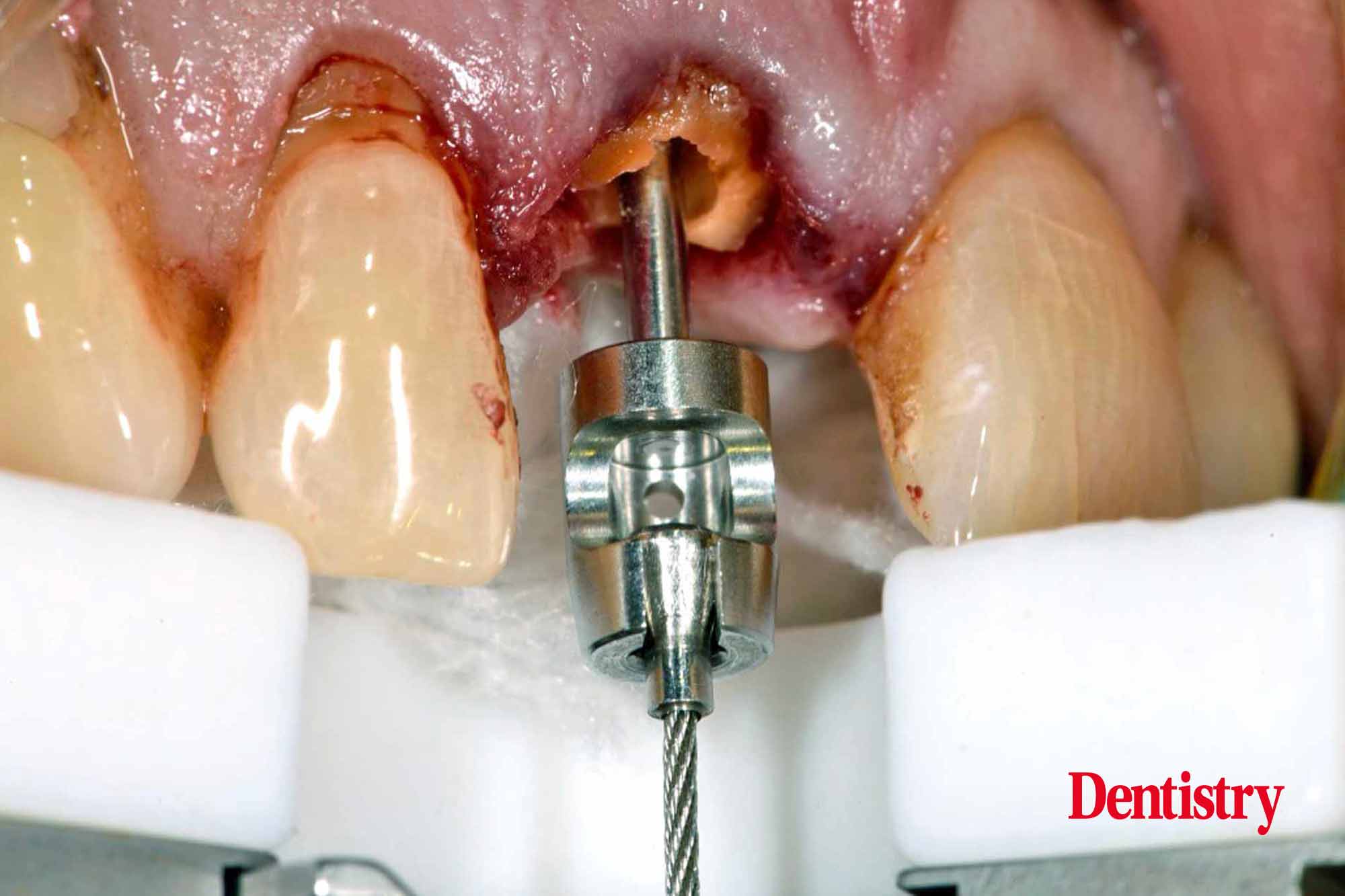 implant patient
