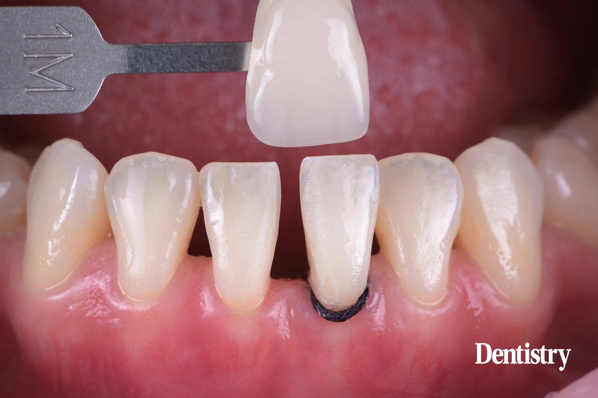 non prep veneers