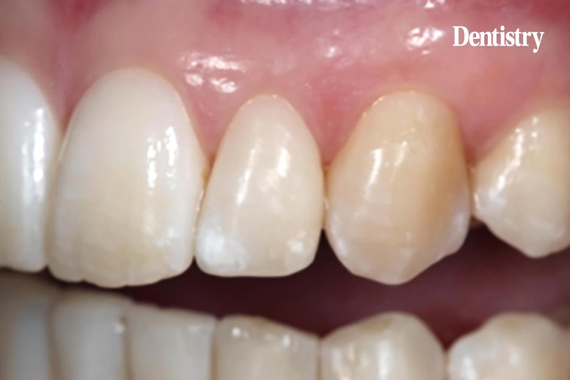 white spot lesions