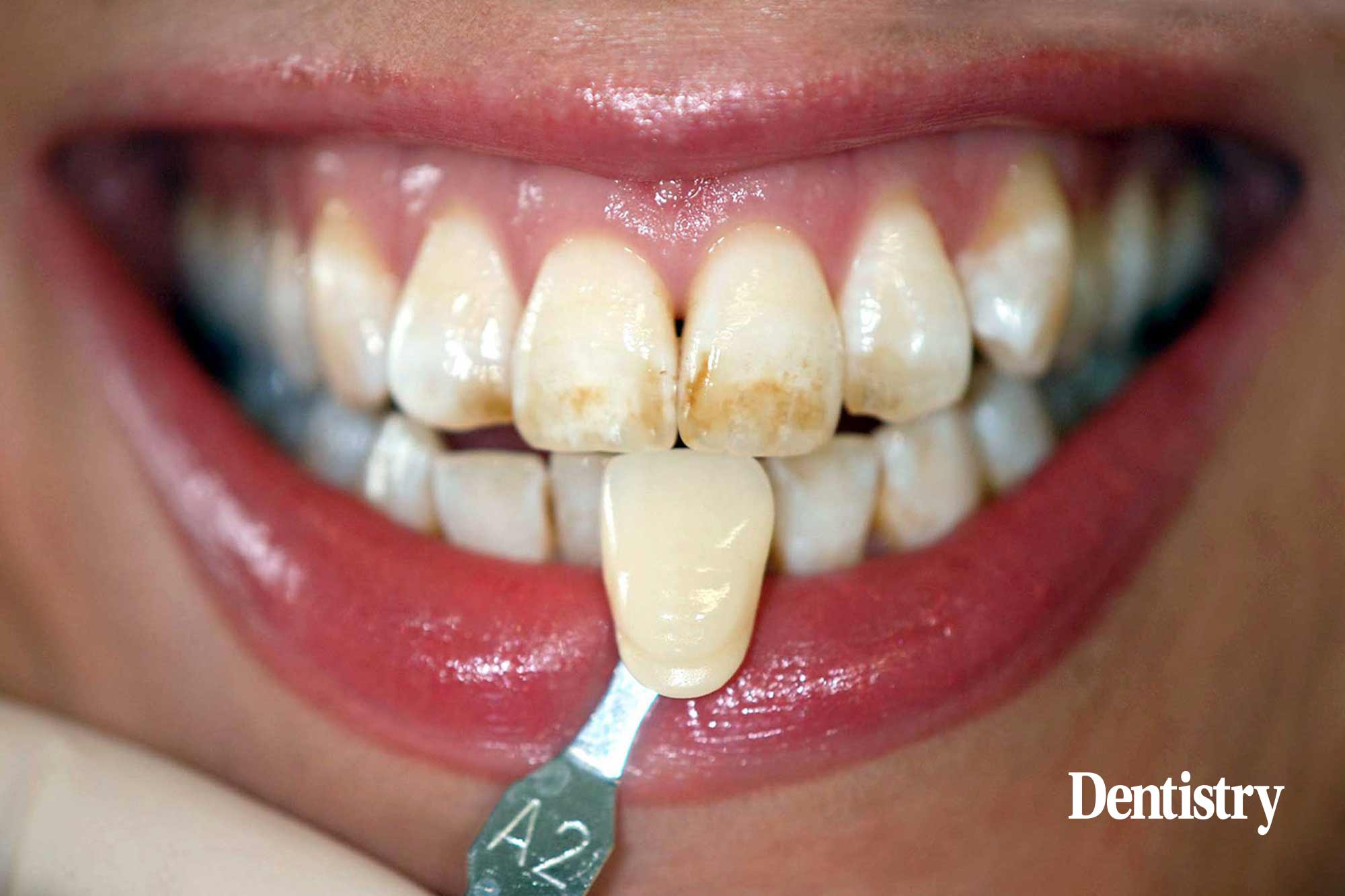 tooth whitening